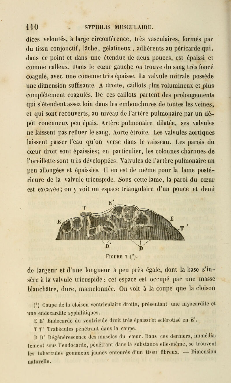 dices veloutés, à large circonférence, très vasculaires, formés par du tissu conjonctif, lâche, gélatineux, adhérents au péricarde qui, dans ce point et dans une étendue de deux pouces, est épaissi et comme calleux. Dans le cœur gauche on trouve du sang très foncé coagulé, avec une couenne très épaisse. La valvule mitrale possède une dimension suffisante. A droite, caillots [lus volumineux etj^lus complètement coagulés. De ces caillots partent des prolongements qui s'étendent assez loin dans les embouchures de toutes les veines, et qui sont recouverts, au niveau de l'artère pulmonaire par un dé- pôt couenneux peu épais. Artère pulmonaire dilatée, ses valvules ne laissent pas refluer le sang. Aorte étroite. Les valvules aortiques laissent passer l'eau qu'on verse dans le vaisseau. Les parois du cœur droit sont épaissies; en particulier, les colonnes charnues de l'oreillette sont très développées. Yalvules de l'artère pulmonaire un peu allongées et épaissies. Il en est de même pour la lame posté- rieure de la valvule tricuspide. Sous cette lame, la paroi du cœur est excavée; on y voit un espace triangulaire d'un pouce et demi Figure 7 (*j. de largeur et d'une longueur à peu près égale, dont la base s'in- sère à la valvule tricuspide ; cet espace est occupé par une masse blanchâtre, dure, mamelonnée. On voit à la coupe que la cloison f) Coupe de la cloison ventriculaire droite, présentant une myocardite et une endocardite syphilitiques. E E' Endocarde du ventricule droit très épaissi et sclérotisé en E'. T T' Trabécules pénétrant dans la coupe. D D' Dégénérescence des muscles du cœur. Dans ces derniers, immédia- tement sous l'endocarde, pénétrant dans la substance elle-même, se trouvent les tubercules gommeux jaunes entourés d'un tissu fibreux. — Dimension naturelle.