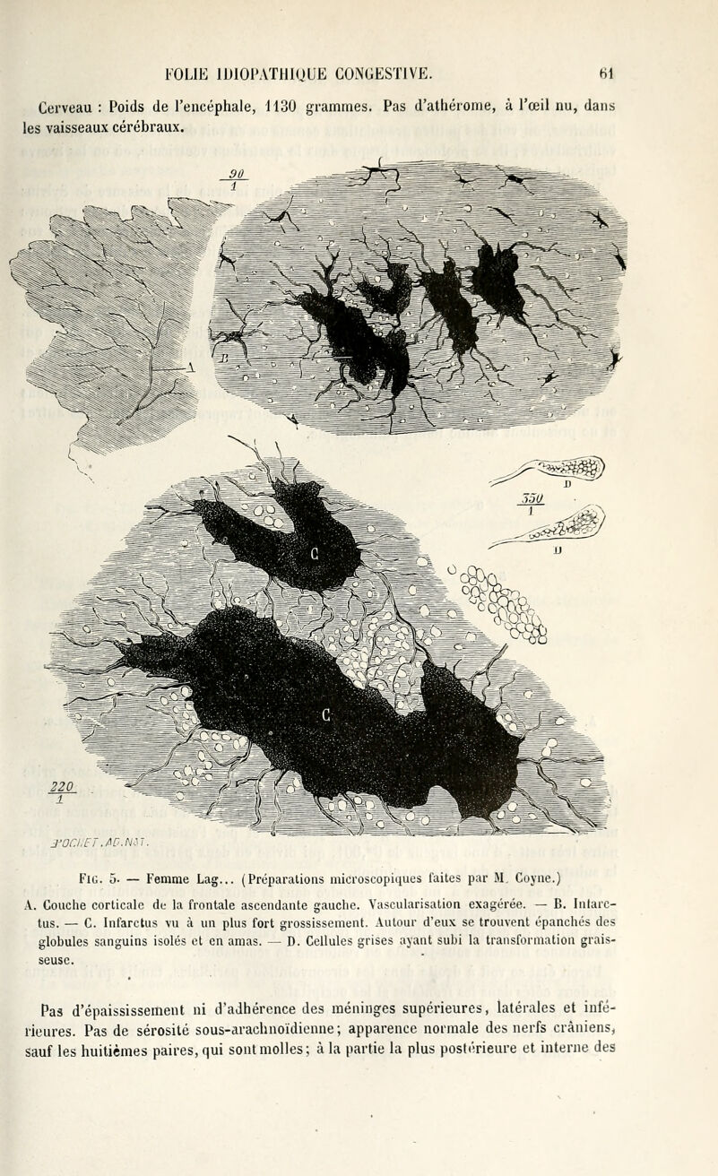 Cerveau : Poids de l'encéphale, 1130 grammes. Pas d'athérome, à l'œil nu, dans les vaisseaux cérébraux. J'OC.IlET.AD.Nil. FlG. 5- — Femme Lag... (Préparations microscopiques faites par M. Coyne.) A. Couche corticale de la frontale ascendante gauche. Vascularisation exagérée. — B. Infarc- tus. — C. Infarctus vu à un plus fort grossissement. Autour d'eux se trouvent épanchés des globules sanguins isolés et en amas. — D. Cellules grises ayant subi la transformation grais- seuse. Pas d'épaississement ni d'adhérence des méninges supérieures, latérales et infé- rieures. Pas de sérosité sous-arachnoïdienne ; apparence normale des nerfs crâniens, sauf les huitièmes paires, qui sont molles; à la partie la plus postérieure et interne des