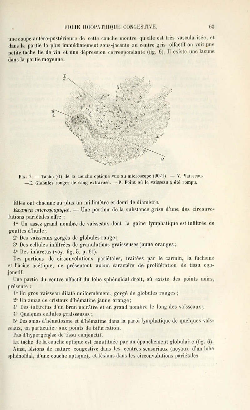 une coupe antéro-postérieure de cette couche montre qu'elle est très vascularisée, et dans la partie la plus immédiatement sous-jacente au centre gris olfactif on voit une petite tache lie de vin et une dépression correspondante (fig. 6). Il existe une lacune dans la partie moyenne. ° -> '■> Fig. 7. — Tache (0) de la couche optique vue au microscope (90/1). — V. Vaisseau. —E. Globules rouges de sang extravasé. — P. Point où le vaisseau a été rompu. Elles ont chacune au plus un millimétré et demi de diamètre. Examen microscopique. — Une portion de la substance grise d'une des circonvo* lutions pariétales offre : 1° Un assez grand nombre de vaisseaux dont la gaine lymphatique est infiltrée de gouttes d'huile ; 2° Des vaisseaux gorgés de globules rouge ; 3° Des cellules infiltrées de granulations graisseuses jaune oranges; 4° Des infarctus (voy. fig. 5, p. 61). Des portions de circonvolutions pariétales, traitées par le carmin, la fuchsine et l'acide acétique, ne présentent aucun caractère de prolifération de tissu cqn- jonctif. Une partie du centre olfactif du lobe sphénoïdal droit, où existe des points noirs, présente ; 1° Un gros vaisseau dilaté uniformément, gorgé de globules rouges ; 2° Un amas de cristaux d'hématine jaune orange ; 4° Des infarctus d'un brun noirâtre et en grand nombre le long des vaisseaux ; 4° Quelques cellules graisseuses ; 5° Des amas d'hématosine et d'hématine dans la paroi lymphatique de quelques vais- seaux, en particulier aux points de bifurcation. Pas d'hypergénèse de tissu conjonctif. La tache delà couche optique est constituée par un épanchement globulaire (fig. 6). Ainsi, lésions de nature congestive dans les centres sensoriaux (noyaux d'un lobe sphénoïdal, d'une couche optique), et lésions dans les circonvolutions pariétales.