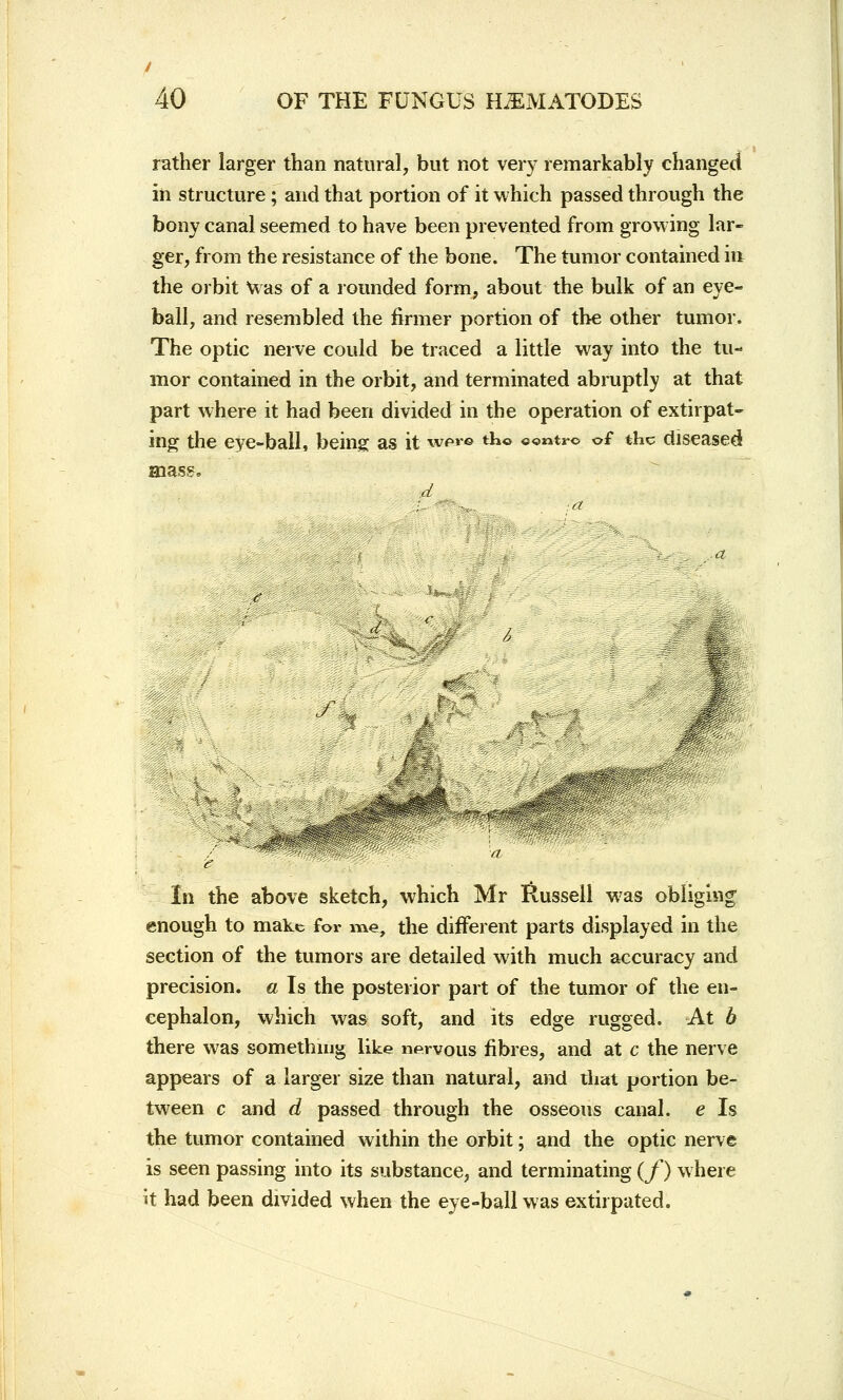 y 40 OF THE FUNGUS HiEMATODES rather larger than natural, but not very remarkably changed in structure ; and that portion of it which passed through the bony canal seemed to have been prevented from growing lar- ger, from the resistance of the bone. The tumor contained in- the orbit was of a rounded form, about the bulk of an eye- ball, and resembled the firmer portion of the other tumor. The optic nerve could be traced a little way into the tu- mor contained in the orbit, and terminated abruptly at that part where it had been divided in the operation of extirpat- ing the eye-ball, being; as it wpr» th© ««ntro of the diseased mass. m In the above sketch, which Mr Russell was obliging enough to make for me, the different parts displayed in the section of the tumors are detailed with much accuracy and precision, a Is the posterior part of the tumor of the en- cephalon, which was soft, and its edge rugged. At b there was something like nervous fibres, and at c the nerve appears of a larger size than natural, and that portion be- tween c and d passed through the osseous canal, e Is the tumor contained within the orbit; and the optic nerve is seen passing into its substance, and terminating (f) where it had been divided when the eye-ball was extirpated.