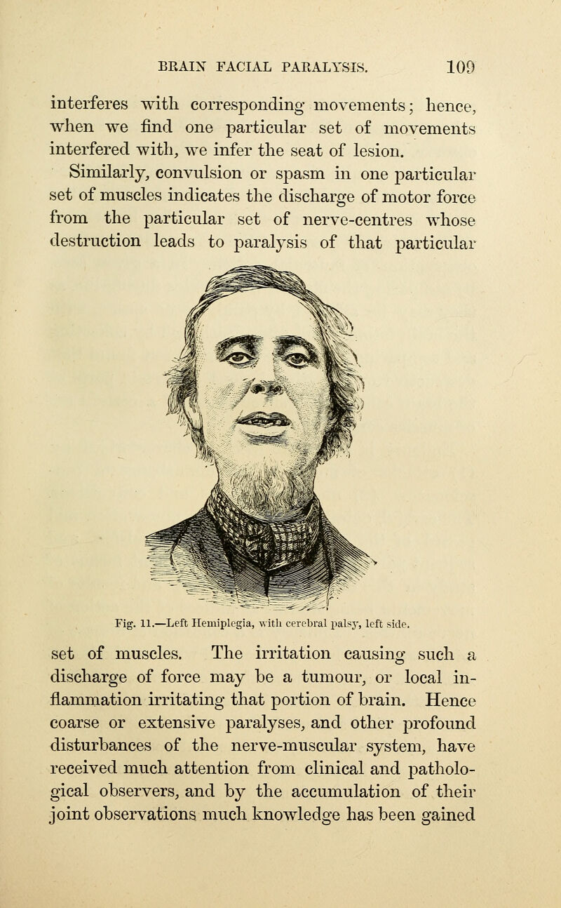 interferes with corresponding movements; hence, when we find one particular set of movements interfered with, we infer the seat of lesion. Similarly, convulsion or spasm in one particular set of muscles indicates the discharge of motor force from the particular set of nerve-centres whose destruction leads to paralysis of that particular Fig. 11.—Left Hemiplegia, with cerebral palsy, left side. set of muscles. The irritation causing such a discharge of force may be a tumour, or local in- flammation irritating that portion of brain. Hence coarse or extensive paralyses, and other profound disturbances of the nerve-muscular system, have received much attention from clinical and patholo- gical observers, and by the accumulation of their joint observations much knowledge has been gained