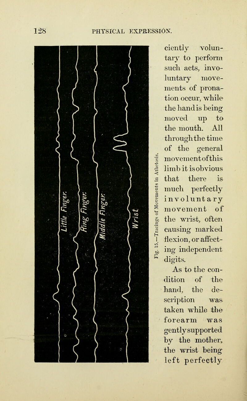 ciently volun- tary to perform sucli acts, invo- luntary move- ments of prona- tion occur, while the hand is being moved up to the mouth. All through the time of the general movement of this limb it is obvious that there is much perfectly involunt a ry movement of the wrist, often causing marked flexion, or affect- ing independent digits. As to the con- dition of the hand, the de- scription was- taken while the forearm was gently supported by the mother, the wrist being left perfectly