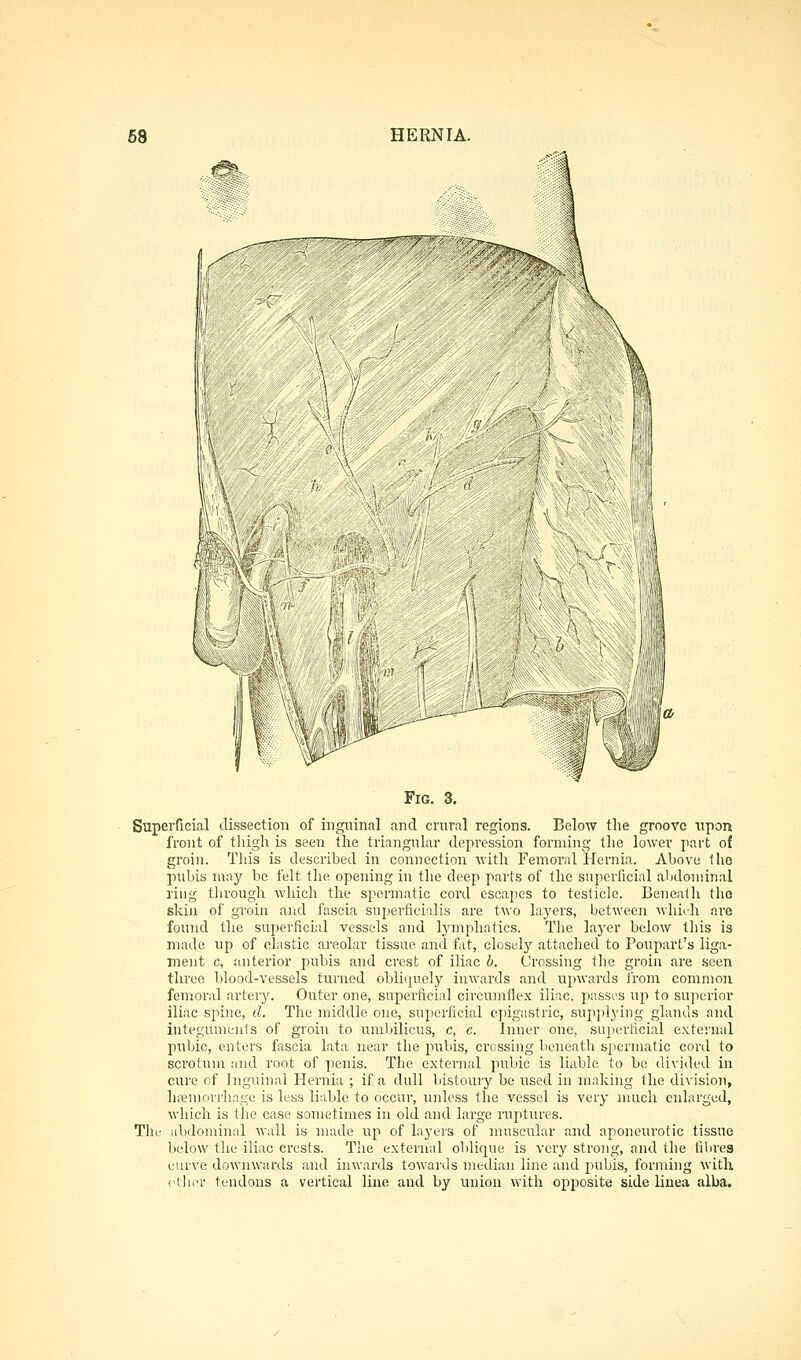 ( v^;- Fig, 3, Superficial dissection of inguinal and cniral regions. Below the groove upon front of thigh is seen the triangular depression forming the lower part of groin. This is described in connection with Femoral Hernia. Above llio pubis may be felt the opening in the deep parts of the superficial abdominal ring tlirough which the spermatic cord escapes to testicle. Benealli tho skin of groin and fascia sujierficialis are two layers, between which are found tlie superficial vessels and lymphatics. The la3'er below this is made up of elastic areolar tissue and fat, closely attached to Poupart's liga- ment c, anterior pubis and crest of iliac h. Crossing the groin are seen three blood-vessels turned obliquely inwards and upwards from common femoral artery. Outer one, superficial circumflex iliac, passes up to superior iliac spine, d. The middle one, superficial e])igastric, supplying glands and integuments of groin to umbilicus, c, c. Inner one, superficial external pubic, enters fascia lata near the pubis, crossing beneatli siiermatic coril to scrotum and root of penis. The external pubic is liable to be divided in cure of Inguinal Hernia ; if a dull bistoury be used in making the division, hrenun'rhnge is less liable to occur, unless the vessel is very much enlarged, which is the case sometimes in old and large ruptures. The abdominal wall is made up of layers of muscular and aponeurotic tissue below the iliac crests. The external oblicpie is very strong, and the fibres curve downwards and inwards towards median line and pubis, forming with (-llioi' tendons a vertical line and by union with opposite side liuea alba.