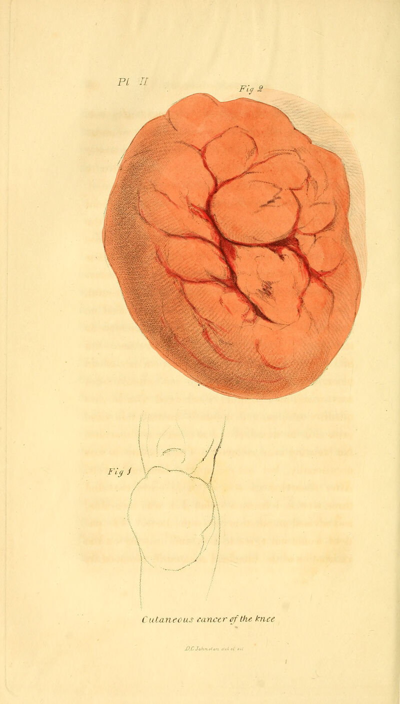 PL n Fla 2 Fiq i Cutaneou.'i cancer of the knee X).r.J„kn.,(tn clUrt: