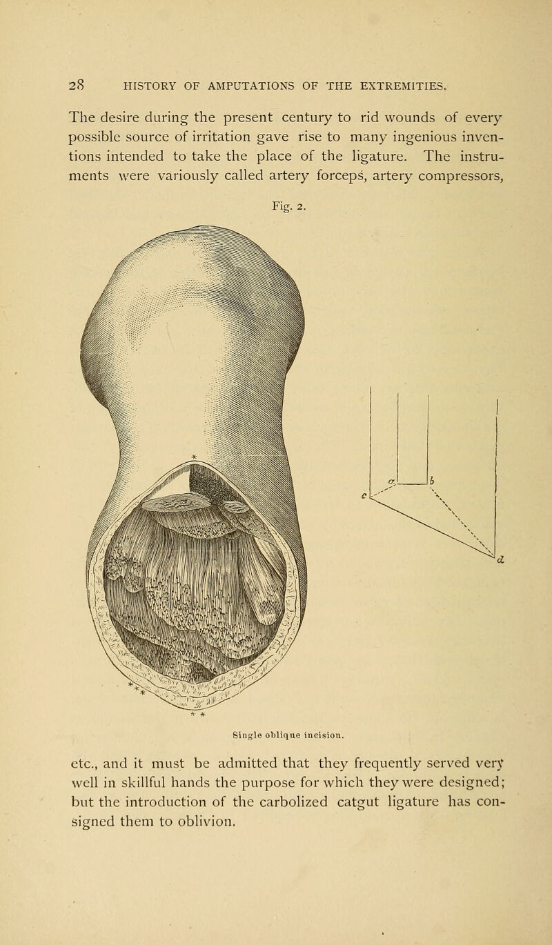 The desire during the present century to rid wounds of every possible source of irritation gave rise to many ingenious inven- tions intended to take the place of the ligature. The instru- ments were variously called artery forceps, artery compressors, Fig. 2. Single oblique incision. etc., and it must be admitted that they frequently served very well in skillful hands the purpose for which they were designed; but the introduction of the carbolized catgut ligature has con- signed them to oblivion.