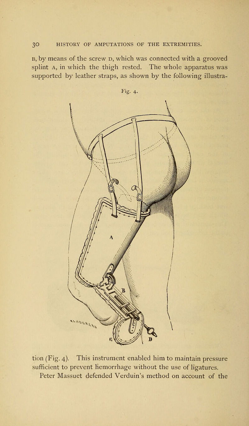 B, by means of the screw d, which was connected with a grooved spHnt A, in which the thigh rested. The whole apparatus was supported by leather straps, as shown by the following illustra- Fig. 4. tion (Fig. 4). This instrument enabled him to maintain pressure sufficient to prevent hemorrhage without the use of ligatures. Peter Massuet defended Verduin's method on account of the