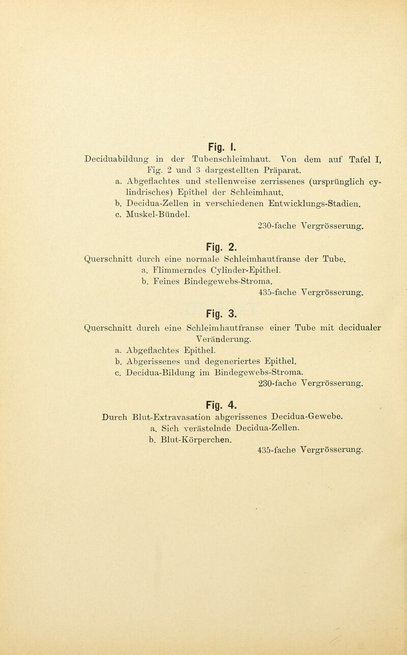 Deciduabildung in der Tubensctileimliaut. Von dem auf Tafel I, Fig. 2 und 3 dargestellten Präparat. a. Abgeflachtes und stellenweise zerrissenes (ursprünglich cy- lindi'isches) Epithel der Schleimhaut. b. Decidua-Zellen in verschiedenen Entwicklungs-Stadien. c. Muskel-Bündel. 230-fache Vergrösserung. Fig. 2. Querschnitt durch eine normale Schleimhautfranse der Tube. a. Flimmerndes Cylinder-Epithel. b. Feines ßindegewebs-Stroma. 435-fache Vergrösserung. Fig. 3. Querschnitt durch eine Schleimhautfranse einer Tube mit decidualer Veränderung. a. Abgeflachtes Epithel. b. Abgerissenes und degeneriertes Epithel. c. Decidua-Bildung im Bindegewebs-Stroma. 230-fache Vergrösserung. Fig. 4. Durch Blut-Extravasation abgerissenes Decidua-Gewebe. a. Sich verästehade Decidua-Zellen. b. Blut-Körperchen. 435-fache Vergrösserung.