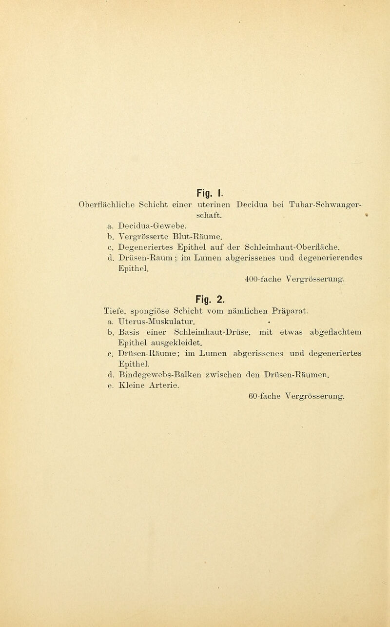 Oberflächliche Schicht einer uterinen Decidua bei Tubar-Schwanger- schaft. a. Decidua-Gewebe. b. Vergrösserte Blut-Eäume. c. Degeneriei'tes Epithel auf der Schleimhaut-Obei-fläche. d. Drüsen-Raum; im Lumen abgerissenes und degenerierendes Epithel, 400-fache Vergrösserung. Fig. 2. Tiefe, spongiöse Schicht vom nämlichen Präparat. a. Uterus-Muskulatur. b. Basis einer Schleimhaut-Drüse, mit etwas abgeflachtem Epithel ausgekleidet. c. Drüsen-Räume; im Lumen abgerissenes und degeneriertes Epithel. d. Bindegewebs-Balken zwischen den Drüsen-Eäumen. e. Kleine Arterie. 60-fache Vergrösserung.