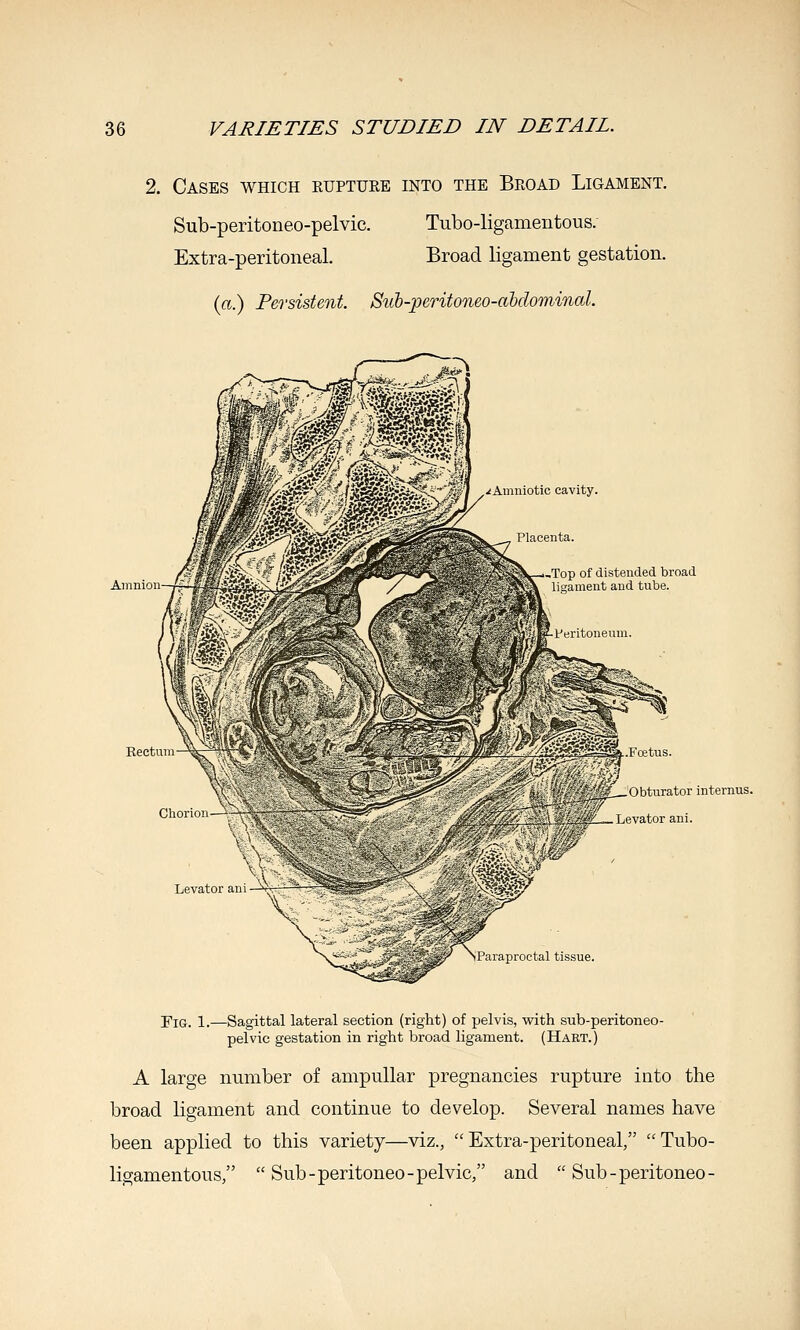 2. Cases which ruptuee into the Beoad Ligament. Sub-peritoneo-pelvic. Tubo-ligamentous. Extra-peritoneal. Broad ligament gestation. (ffi.) Persistent. Suh-peritoneo-abdominal. Amnion -Top of distended broad lisrament and tube Bectum Cliorion Obturator internus. Levator ani. Piiaproctal tissue Fig. 1.—Sagittal lateral section (right) of pelvis, with sub-peritoneo- pelvic gestation in right broad ligament. (Hart.) A large number of ampullar pregnancies rupture into the broad ligament and continue to develop. Several names have been applied to this variety—viz., Extra-peritoneal/' Tubo- ligamentous, Sub-peritoneo-pelvic, and  Sub-peritoneo-