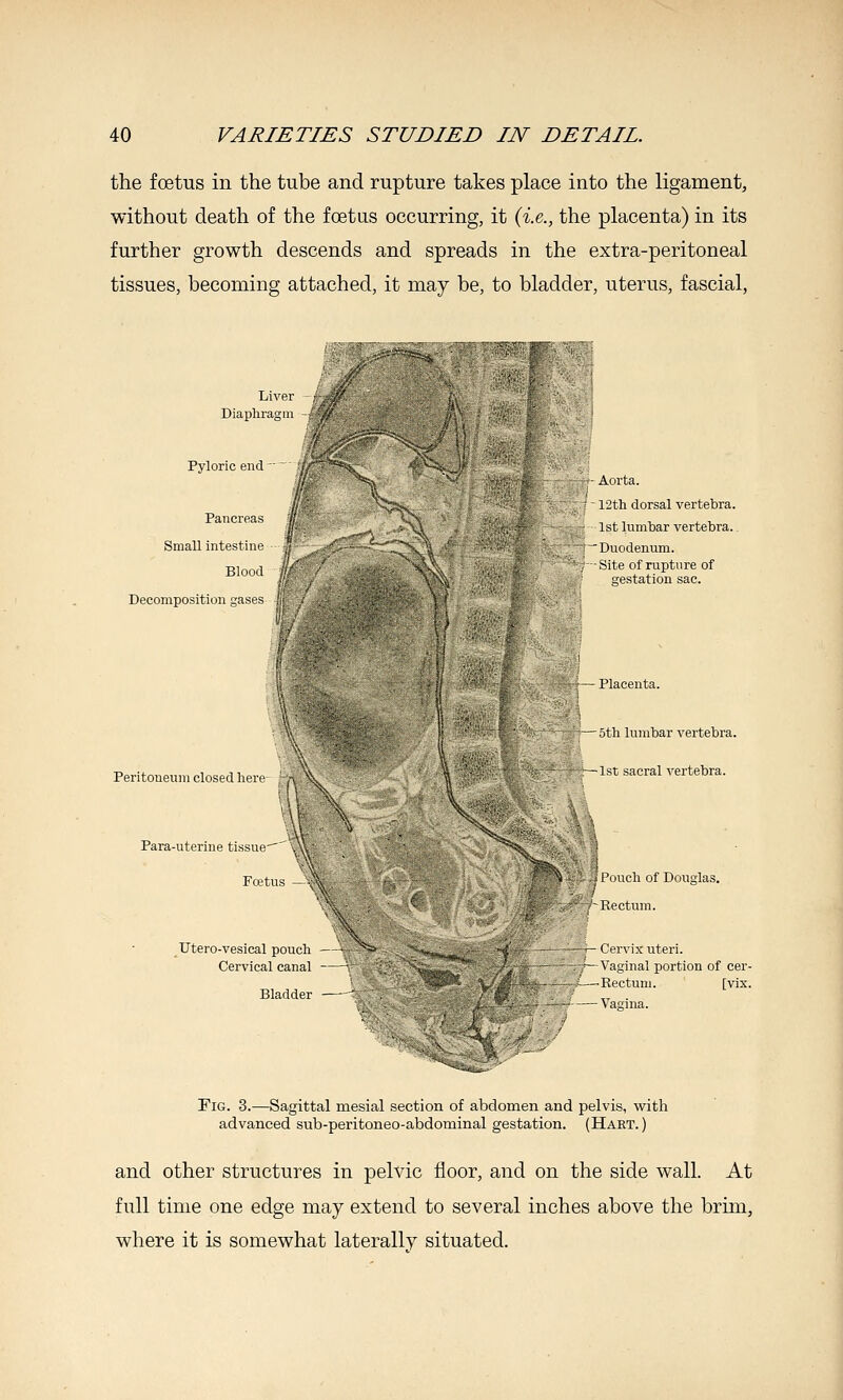 the foetus in the tube and rupture takes place into the ligament, without death of the foetas occurring, it {i.e., the placenta) in its further growth descends and spreads in the extra-peritoneal tissues, becoming attached, it may be, to bladder, uterus, fascial, Liver Diaphragm Pyloric end' ^ Pancreas Small intestine Blood Decomposition gase^ Aorta. 12th dorsal vertebra. 1st lumbar vertebra.. ' Duodenum. Site of rupture of gestation sac. - - Placenta. Peritoneum closed here Para-uterine tissue Foetus ■ 5th lumbar vertebra. -1st sacral vertebra. Pouch of Douglas. Rectum. Utero-vesical pouch Cervical canal Bladder — - Cervix uteri. Vaginal portion of cer- -Rectum. [vix. - Vagina. Fig. 3.—Sagittal mesial section of abdomen and pelvis, with advanced sub-peritoneo-abdominal gestation. (Hart.) and other structures in pelvic floor, and on the side wall. At full time one edge may extend to several inches above the brim, where it is somewhat laterally situated.