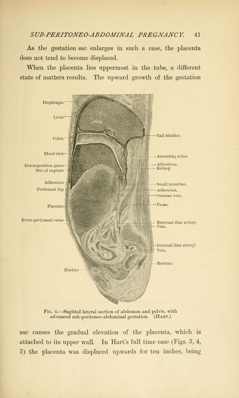 As the gestation sac enlarges in such a case, the placenta does not tend to become displaced. When the placenta lies uppermost in the tube, a different state of matters results. The upward growth of the gestation Diaphragm Colon Blood clot- Decomposition gases Site of rupture Adliesions Peritoneal dip Extra-peritoneal veins -' (iall bladder. Ascending colon Small intestine. Adhesions. Ovarian vein. External iliac artery. Vein. Internal iliac artery*. Vein. Rectum. Fig. 4.—Sagittal lateral section of abdomen and pelvis, w4th advanced sub-peritoneo-abdominal gestation. (Hart.) sac causes the gradual elevation of the placenta, which is attached to its upper wall. In Hart's full time case (Figs. 3, 4, 5) the placenta was displaced upwards for ten inches, being