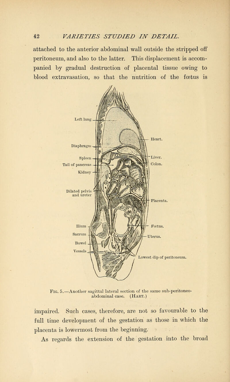 attached to the anterior abdominal wall outside the stripped off peritoneum, and also to the latter. This displacement is accom- panied by gradual destruction of placental tissue owing to blood extravasation, so that the nutrition of the foetus is Diaphragm Spleen Tail of pancreas Kidney Dilated pelvis and ureter Ilium Sacrum Bowel Vessels Placenta. Pcetus. Uterus. Lowest dip of peritoneum. Fig. 5.—Another sagittal lateral section of the same sub-peritoneo- abdominal case. (Haet. ) impaired. Such cases, therefore, are not so favourable to the full time development of the gestation as those in which the placenta is lowermost from the beginning. As regards the extension of the gestation into the broad