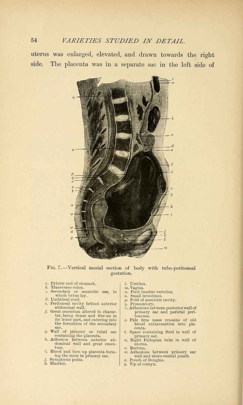 uterus was enlarged, elevated, and drawn towards the right side. The placenta was in a separate sac in the left side of Fig. 7. -Vertical mesial section of body with tubo-peritoneal gestation. Pyloric end of stomach. Transverse colon. Secondary or amniotic sac, in whicli lojtus lay. Umbilical cord. Peritoneal cavity behind anterior abdominal wall. Great omentum altered in charac- ter, being dense and tibrous in its inner part, and entering into the formation of the secondary sac. Wall of primary or tubal sac containing the placenta. Adhesion between anterior ab- dominal wall and great o]nen- tuni. Blood and torn up placenta form- ing the mass in primary sac. • Symphysis pubis. Bladder. I. Urethra. in. Vagina. n. First lumbar vertebra. 0. Small intestines. p. Fold of amniotic cavity. (jf. Promontory. r. Adhesions between posterior wall of primary sac and parietal peri- toneum. s. Pale firm mass remains of old blood extravasation into pla- centa. t. Space containing fluid in wall of primary sac. u. Eight Fallopian tube in wall of uterus. V. Rectum. w. Adhesions between primary sac wall and utero-vesical pouch. X. Pouch of Douglas. y. Tip of coccyx. \
