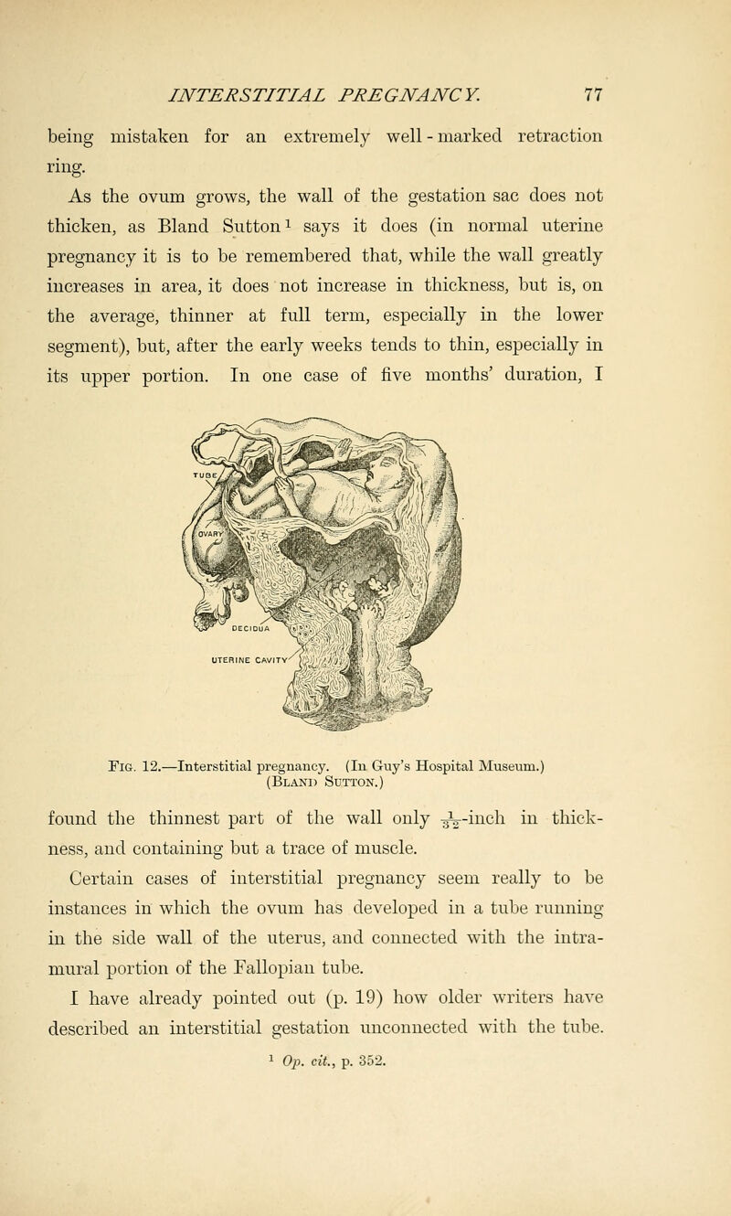 being mistaken for an extremely well-marked retraction ring. As the ovum grows, the wall of the gestation sac does not thicken, as Bland Sutton i says it does (in normal uterine pregnancy it is to be remembered that, while the wall greatly increases in area, it does not increase in thickness, but is, on the average, thinner at full term, especially in the lower segment), but, after the early weeks tends to thin, especially in its upper portion. In one case of five months' duration, I Fig. 12.—Interstitial pregnancy. (In Guy's Hospital Museum.) (Bland Sutton.) found the thinnest part of the wall only ^-inch in thick- ness, and containing but a trace of muscle. Certain cases of interstitial pregnancy seem really to be instances in which the ovum has developed in a tube running in the side wall of the uterus, and connected with the intra- mural portion of the Fallopian tube. I have already pointed out (p. 19) how older writers have described an interstitial gestation unconnected with the tube. 1 Op. eit., p. 352.