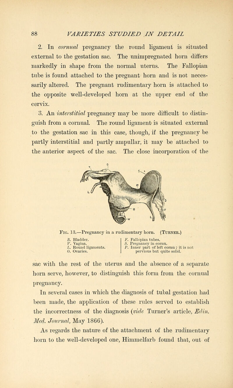 2. In cornual pregnancy the round ligament is situated external to the gestation sac. The unimpregnated horn differs markedly in shape from the normal uterus. The Fallopian tube is found attached to the pregnant horn and is not neces- sarily altered. The pregnant rudimentary horn is attached to the opposite well-developed horn at the upper end of the cervix. 3. An interstitial pregnancy may be more difficult to distin- guish from a cornual. The round ligament is situated external to the gestation sac in this case, though, if the pregnancy be partly interstitial and partly ampullar, it may be attached to the anterior aspect of the sac. The close incorporation of the Fig. 13.—Pregnancy in a rudimentary horn. (Turner.) B. Bladder. V. Vagiua. L. Round ligaments. 0. Ovaries. F. Fallopian tubes. S. Pregnancy in cornu. P. Inner part of left cornu ; it is not pervious but quite solid. sac with the rest of the uterus and the absence of a separate horn serve, however, to distinguish this form from the cornual pregnancy. In several cases in which the diagnosis of tubal gestation had been made, the application of these rules served to establish the incorrectness of the diagnosis {vide Turner's article, Edin. Med. Journal, May 1866). As regards the nature of the attachment of the rudimentary horn to the well-developed one, Himmelfarb found that, out of