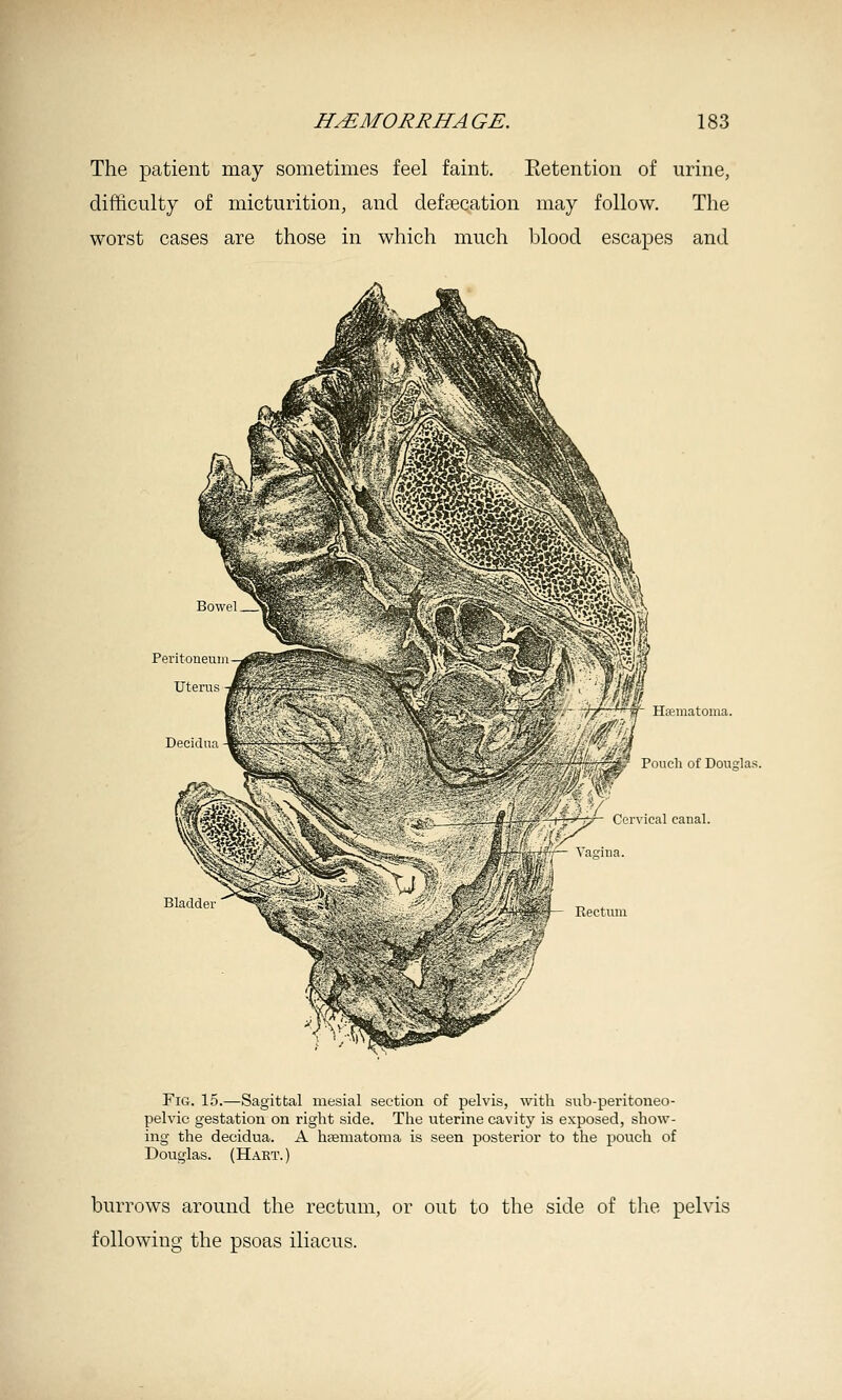 The patient may sometimes feel faint. Eetention of urine, difficulty of micturition, and deftecation may follow. The worst cases are those in which much blood escapes and Hfematoma. Pouch of Douglas. \ ical canal. Fig. 15.—Sagittal mesial section of pelvis, with sub-peritoneo- pelvic gestation on right side. The uterine cavity is exposed, show- ing the decidua. A hsematoma is seen posterior to the pouch of Douglas. (Hart.) burrows around the rectum, or out to the side of the pelvis following the psoas iliacus.