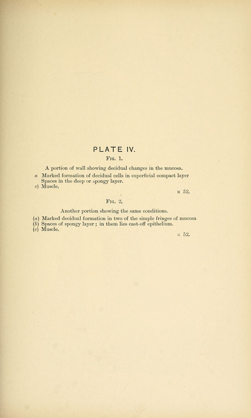 Fig. 1. A portion of wall showing decidual changes in the mucosa. a Marked formation of decidual cells in superficial compact layer Spaces in the deep or spongy layer, c) Muscle. X 52. Fig. 2. Another portion showing the same conditions. (ft) Marked decidual formation in two of the simple fringes of mucosa (6) Spaces of spongy layer; in them lies cast-off epithelium, (c) Muscle. X 52.
