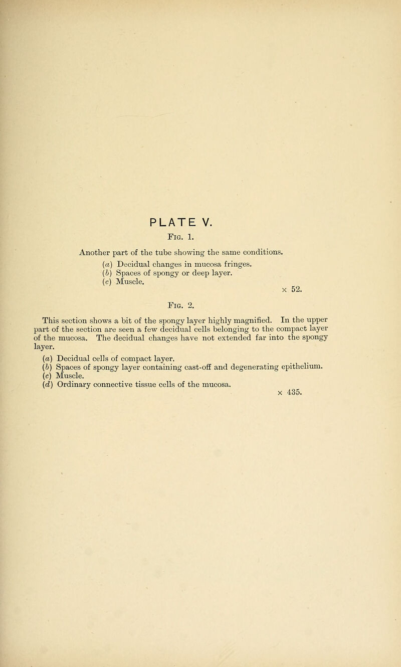 Fig. 1. Another part of the tube showing the same conditions. (a) Decidual changes in mucosa fringes. (b) Spaces of spongy or deep layer. (c) Muscle. X 52. Fig. 2. This section shows a bit of the spongy layer highly magnified. In the upper part of the section are seen a few decidual cells belonging to the compact layer of the mucosa. The decidual changes have not extended far into the spongy layer. (a) Decidual cells of compact layer. (b) Spaces of spongy layer containing cast-off and degenerating epithelium. (c) Muscle. (d) Ordinary connective tissue cells of the mucosa. X 435.