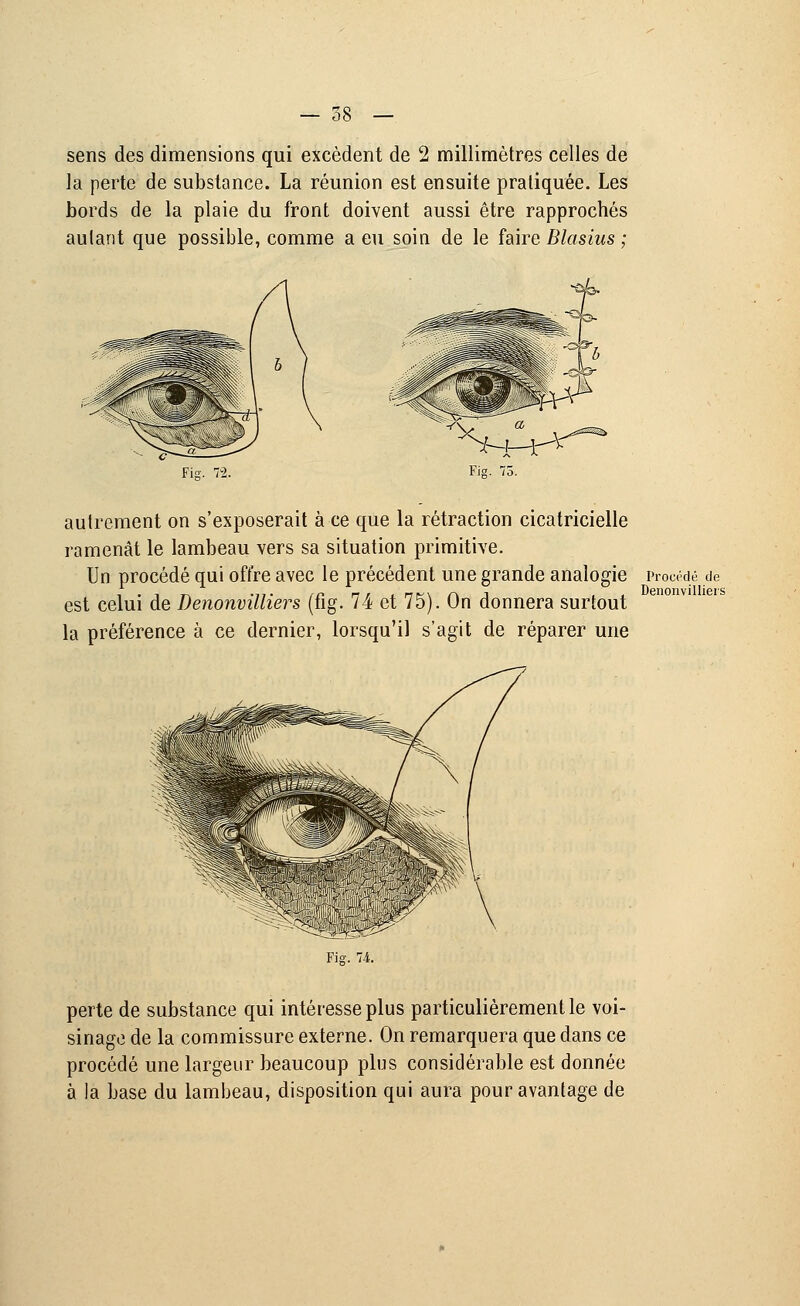 — 38 — sens des dimensions qui excèdent de 2 millimètres celles de la perte de substance. La réunion est ensuite pratiquée. Les bords de la plaie du front doivent aussi être rapprochés aulant que possible, comme a eu soio de le faire Blasius ; SfHHr^ Fis. 72. Fis. 75. autrement on s'exposerait à ce que la rétraction cicatricielle ramenât le lambeau vers sa situation primitive. Un procédé qui offre avec le précédent une grande analogie est celui de Denonvilliers (fig. 74 et 75). On donnera surtout la préférence à ce dernier, lorsqu'il s'agit de réparer une l^:lWKi^ Procédé de Denonvilliers Fig. 74. perte de substance qui intéresse plus particulièrement le voi- sinage de la commissure externe. On remarquera que dans ce procédé une largeur beaucoup plus considérable est donnée à la base du lambeau, disposition qui aura pour avantage de