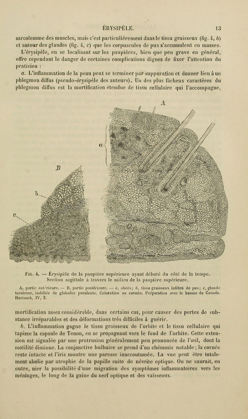 sarcoJemme des muscles, mais c'est particulièrement dans le tissu graisseux (fig. 4, b) et autour des glandes (fig. 4, c) que les corpuscules de pus s'accumulent en masses. L'érysipèle, en se localisant sur les paupières, bien que peu grave en général, offre cependant le danger de certaines complications dignes de fixer l'attention du praticien : a. L'inflammation de la peau peut se terminer par suppuration et donner lieu à un phlegmon diffus (pseudo-érysipèle des auteurs). Un des plus fâcheux caractères du phlegmon diffus est la mortification étendue de tissu cellulaire qui l'accompagne, Fig. A. — Érysipèle de la paupière supérieure ayant débuté du côté de la tempe. Section sagittale à travers le milieu de la paupière supérieure. A, partie antérieure.— B, partie postérieure. — a, abcès; b, tissu graisseux infiltré de pus; c, glande tarsienne, inihibe'e de globules purulents. Coloration au carmin. Préparation avec le baume de Canada. Harlnack, IV, 3. mortification assez considérable, dans certains cas, pour causer des pertes de sub- stance irréparables et des déformations très difficiles à guérir. b. L'inflammation gagne le tissu graisseux de l'orbite et le tissu cellulaire qui tapisse la capsule de Tenon, en se propageant vers le fond de l'orbite. Cette exten- sion est signalée par une protrusion généralement peu prononcée de l'œil, dont la inutilité diminue. La conjonctive bulbaire se prend d'un chémosis notable ; la cornée reste intacte et l'iris montre une paresse inaccoutumée. La vue peut être totale- ment abolie par atrophie de la papille suite de névrite optique. On ne saurait, en outre, nier la possibilité d'une migration des symptômes inflammatoires vers les méninges, le long de la gaine du nerf optique et des vaisseaux.