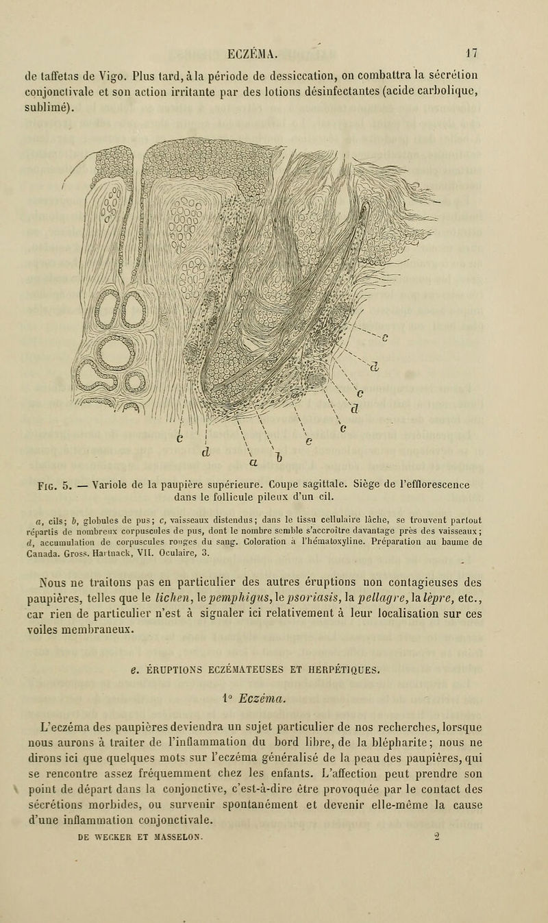 de taffetas de Vigo. Plus tard, à la période de dessiccation, on combattra la sécrétion eonjonctivale et son action irritante par des lotions désinfectantes (acide carbolique, sublimé). Fig. 5. — Variole de la paupière supérieure. Coupe sagittale. Siège de l'efflorescence dans le follicule pileux d'un cit. a, cils; 6, globules de pus; c, vaisseaux distendus; dans le tissu cellulaire lâche, se trouvent partout répartis de nombreux corpuscules de pus, dont le nombre semble s'accroître davantage près des vaisseaux; d, accumulation de corpuscules ronges du sang. Coloration à l'hématoxyline. Préparation au baume de Canada. Gross. Hartnack, VII. Oculaire, 3. ]\ous ne traitons pas en particulier des autres éruptions non contagieuses des paupières, telles que le lichen, \epemphigus, le psoriasis, la pellagre, la lèpre, etc., car rien de particulier n'est à signaler ici relativement à leur localisation sur ces voiles membraneux. e. ÉRUPTIONS ECZEMATEUSES ET HERPETIQUES. 1° Eczéma. L'eczéma des paupières deviendra un sujet particulier de nos recherches, lorsque nous aurons à traiter de l'inflammation du bord libre, de la blépharite; nous ne dirons ici que quelques mots sur l'eczéma généralisé de la peau des paupières, qui se rencontre assez fréquemment chez les enfants. L'affection peut prendre son point de départ dans la conjonctive, c'est-à-dire être provoquée par le contact des sécrétions morbides, ou survenir spontanément et devenir elle-même la cause d'une inflammation eonjonctivale. DE WECKER ET MASSELON. ±