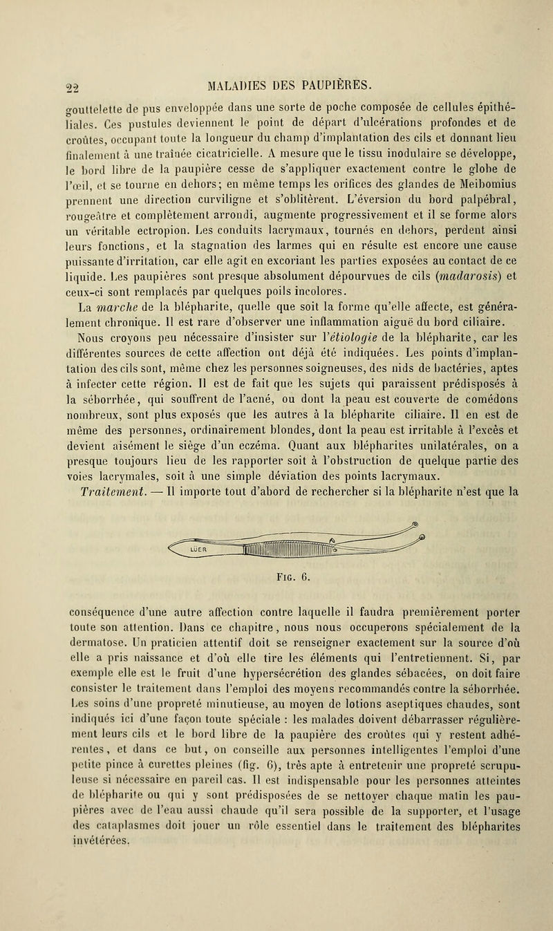o-outtelette de pus enveloppée dans une sorte de poche composée de cellules épithé- liales. Ces pustules deviennent le point de départ d'ulcérations profondes et de croûtes, occupant toute la longueur du champ d'implantation des cils et donnant lieu finalement à une traînée cicatricielle. A mesure que le tissu inodulaire se développe, le hord libre de la paupière cesse de s'appliquer exactement contre le globe de l'œil, et se tourne en dehors; en même temps les orifices des glandes de Meibomius prennent une direction curviligne et s'oblitèrent. L'éversion du bord palpébral, rougeàtre et complètement arrondi, augmente progressivement et il se forme alors un véritable ectropion. Les conduits lacrymaux, tournés en dehors, perdent ainsi leurs fonctions, et la stagnation des larmes qui en résulte est encore une cause puissante d'irritation, car elle agit en excoriant les parties exposées au contact de ce liquide. Les paupières sont presque absolument dépourvues de cils (madarosis) et ceux-ci sont remplacés par quelques poils incolores. La marche de la blépharite, quelle que soit la forme qu'elle affecte, est généra- lement chronique. 11 est rare d'observer une inflammation aiguë du bord ciliaire. Nous croyons peu nécessaire d'insister sur Yétiologie de la blépharite, caries différentes sources de cette affection ont déjà été indiquées. Les points d'implan- tation des cils sont, même chez les personnes soigneuses, des nids de bactéries, aptes à infecter cette région. Il est de fait que les sujets qui paraissent prédisposés à la séborrhée, qui souffrent de l'acné, ou dont la peau est couverte de comédons nombreux, sont plus exposés que les autres à la blépharite ciliaire. Il en est de même des personnes, ordinairement blondes, dont la peau est irritable à l'excès et devient aisément le siège d'un eczéma. Quant aux blépharites unilatérales, on a presque toujours lieu de les rapporter soit à l'obstruction de quelque partie des voies lacrymales, soit à une simple déviation des points lacrymaux. Traitement. — Il importe tout d'abord de rechercher si la blépharite n'est que la Fig. 6. conséquence d'une autre affection contre laquelle il faudra premièrement porter toute son attention. Dans ce chapitre, nous nous occuperons spécialement de la dermatose. Un praticien attentif doit se renseigner exactement sur la source d'où elle a pris naissance et d'où elle tire les éléments qui l'entretiennent. Si, par exemple elle est le fruit d'une hypersécrétion des glandes sébacées, on doit faire consister le traitement dans l'emploi des moyens recommandés contre la séborrhée. Les soins d'une propreté minutieuse, au moyen de lotions aseptiques chaudes, sont indiqués ici d'une façon toute spéciale : les malades doivent débarrasser régulière- ment leurs cils et le bord libre de la paupière des croûtes qui y restent adhé- rentes, et dans ce but, on conseille aux personnes intelligentes l'emploi d'une petite pince à curettes pleines (fig. 6), très apte à entretenir une propreté scrupu- leuse si nécessaire en pareil cas. Il est indispensable pour les personnes atteintes de blépharite ou qui y sont prédisposées de se nettoyer chaque matin les pau- pières avec de l'eau aussi chaude qu'il sera possible de la supporter, et l'usage des cataplasmes doit jouer un rôle essentiel dans le traitement des blépharites invétérées.
