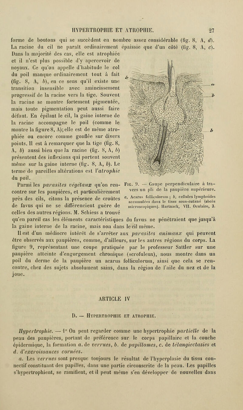 :b forme de boutons qui se succèdent en nombre assez considérable (fig. 8, A, d). La racine du cil ne paraît ordinairement épaissie que d'un côté (fig. 8, A, c). Dans la majorité des cas, elle est atrophiée et il n'est plus possible d'y apercevoir de noyaux. Ce qu'on appelle d'habitude le col du poil manque ordinairement tout à fait (fig. 8, A, b), en ce sens qu'il existe une transition insensible avec amincissement progressif de la racine vers la tige. Souvent la racine se montre fortement pigmentée, mais toute pigmentation peut aussi faire défaut. En épilant le cil, la gaine interne de la racine accompagne le poil (comme le montre la figure 8, A); elle est de même atro- phiée ou encore comme gonflée sur divers points. Il est à remarquer que la tige (fig. 8, A, b) aussi bien que la racine (fig. 8, A, b) présentent des inflexions qui portent souvent même sur la gaine interne (fig. 8, A, b). Le terme de pareilles altérations est l'atrophie du poil. Parmi les parasites végétaux qu'on ren- Fig. 9. contre sur les paupières, et particulièrement près des Cils, Citons la présence de Croûtes a> Acarus follieulorum; b, cellules lymphoïdes r r accumulées dans le tissu sous-cutano (abcès de favus qui ne se différencient guère de microscopiques). Hartnack, VII. Oculaire, 3. celles des autres régions. M. Schiess a trouvé qu'en pareil cas les éléments caractéristiques du favus ne pénétraient que jusqu'à la gaine interne de la racine, mais non dans le cil même. Il est d'un médiocre intérêt de s'arrêter aux parasites animaux qui peuvent être observés aux paupières, comme, d'ailleurs, sur les autres régions du corps. La figure 9, représentant une coupe pratiquée par le professeur Sattler sur une paupière atteinte d'engorgement chronique (scrofuleux), nous montre dans un poil du derme de la paupière un acarus folliculorum, ainsi que cela se ren- contre, chez des sujets absolument sains, dans la région de l'aile du nez et de la joue. Coupe perpendiculaire à tra- vers un pli de la paupière supérieure. ARTICLE IV D. — Hypertrophie et atrophie. Hypertrophie.—1° On peut regarder comme une hypertrophie partielle de la peau des paupières, portant de préférence sur le corps papillaire et la couche épidermique, la formation a. de verrues, b. de papillomes, c. de télangiectasies et d. d'excroissances cornées. a. Les verrues sont presque toujours le résultat de l'hyperplasie du tissu con- nectif constituant des papilles, dans une partie circonscrite de la peau. Les papilles s'hypertrophient, se ramifient, et il peut même s'en développer de nouvelles dans
