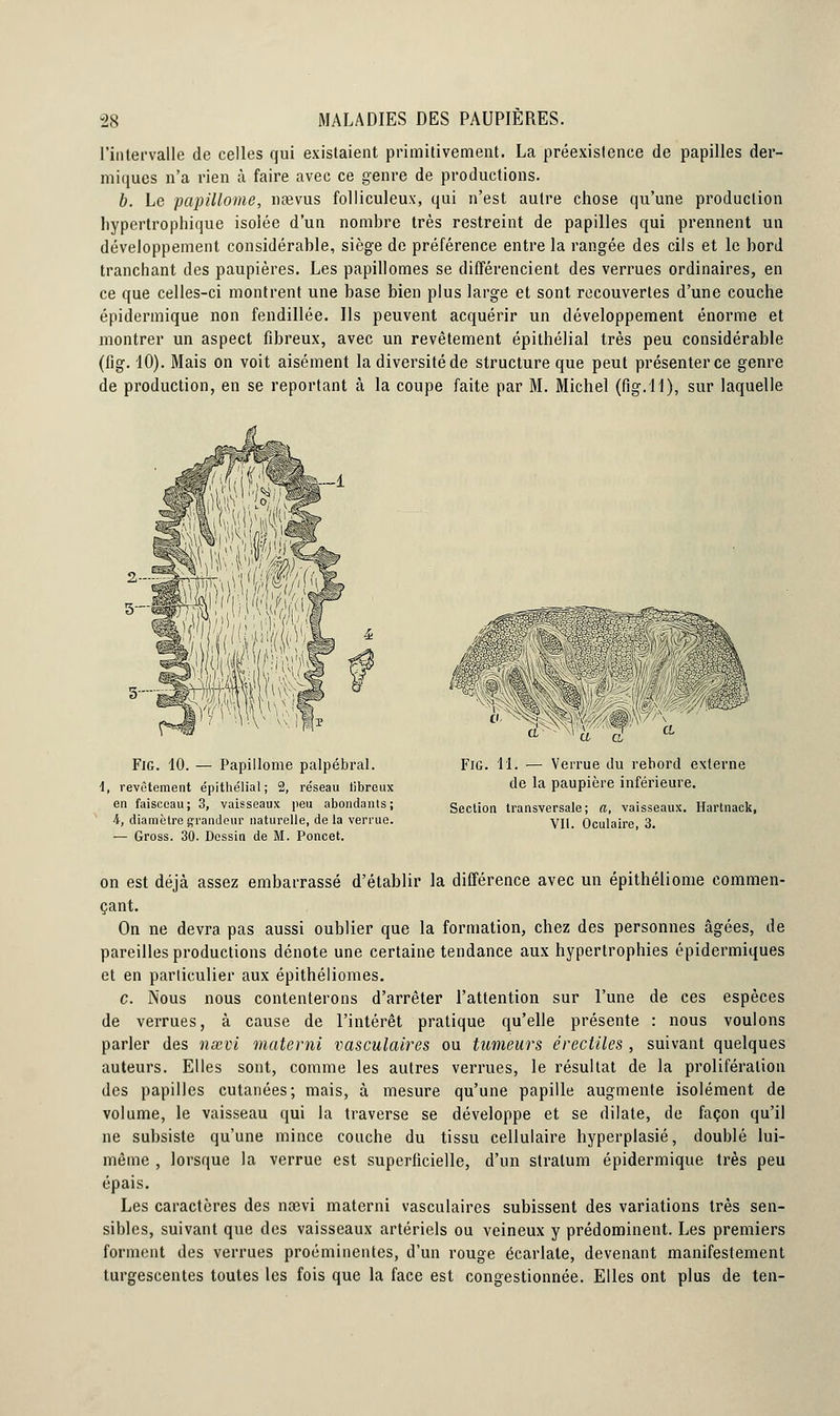 l'intervalle de celles qui existaient primitivement. La préexistence de papilles der- miques n'a rien à faire avec ce genre de productions. b. Le papillome, nœvus folliculeux, qui n'est autre chose qu'une production hypertrophiée isolée d'un nombre très restreint de papilles qui prennent un développement considérable, siège de préférence entre la rangée des cils et le bord tranchant des paupières. Les papillomes se différencient des verrues ordinaires, en ce que celles-ci montrent une base bien plus large et sont recouvertes d'une couche épidermique non fendillée. Ils peuvent acquérir un développement énorme et montrer un aspect fibreux, avec un revêtement épithélial très peu considérable (lîg. 10). Mais on voit aisément la diversité de structure que peut présenter ce genre de production, en se reportant à la coupe faite par M. Michel (fig.ll), sur laquelle FiG. 10. — Papillome palpébral. d, revêtement épithélial ; 2, réseau fibreux en faisceau; 3, vaisseaux peu abondants; 4, diamètre grandeur naturelle, delà verrue. — Gross. 30. Dessin de M. Poncet. FiG. 11. — Verrue du rebord externe de la paupière inférieure. Section transversale; a, vaisseaux. Hartnack, Vil. Oculaire, 3. on est déjà assez embarrassé d'établir la différence avec un épithéliome commen- çant. On ne devra pas aussi oublier que la formation, chez des personnes âgées, de pareilles productions dénote une certaine tendance aux hypertrophies épidermiques et en particulier aux épithéliomes. c. Nous nous contenterons d'arrêter l'attention sur l'une de ces espèces de verrues, à cause de l'intérêt pratique qu'elle présente : nous voulons parler des nxvi materni vasculaires ou tumeurs érecliles , suivant quelques auteurs. Elles sont, comme les autres verrues, le résultat de la prolifération des papilles cutanées; mais, à mesure qu'une papille augmente isolément de volume, le vaisseau qui la traverse se développe et se dilate, de façon qu'il ne subsiste qu'une mince couche du tissu cellulaire hyperplasié, doublé lui- même , lorsque la verrue est superficielle, d'un stratum épidermique très peu épais. Les caractères des nœvi materni vasculaires subissent des variations très sen- sibles, suivant que des vaisseaux artériels ou veineux y prédominent. Les premiers forment des verrues proéminentes, d'un rouge écarlate, devenant manifestement turgescentes toutes les fois que la face est congestionnée. Elles ont plus de ten-
