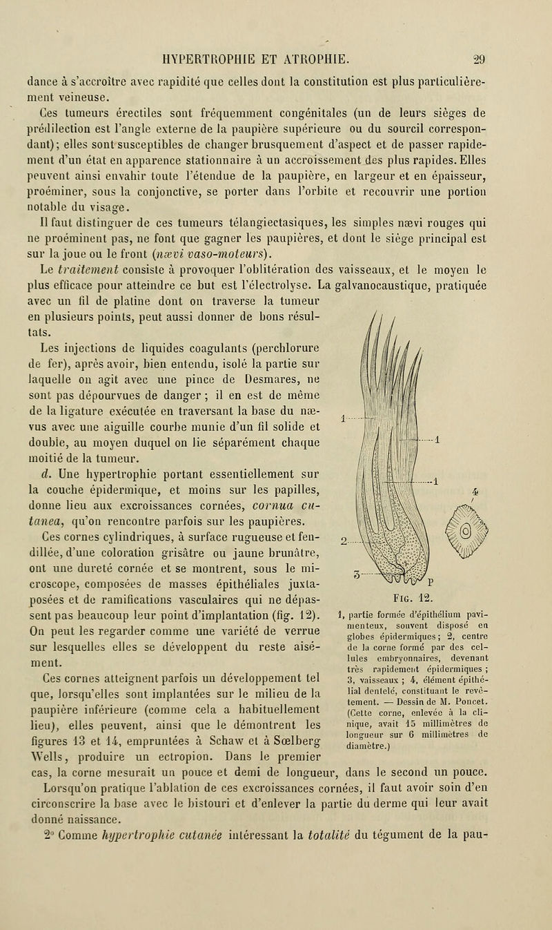 dance à s'accroître avec rapidité que celles dont la constitution est plus particulière- ment veineuse. Ces tumeurs érectiles sont fréquemment congénitales (un de leurs sièges de prédilection est l'angle externe de la paupière supérieure ou du sourcil correspon- dant); elles sont susceptibles de changer brusquement d'aspect et de passer rapide- ment d'un état en apparence stationnaire à un accroissement des plus rapides. Elles peuvent ainsi envahir toute l'étendue de la paupière, en largeur et en épaisseur, proéminer, sous la conjonctive, se porter dans l'orbite et recouvrir une portion notable du visage. Il faut distinguer de ces tumeurs télangiectasiques, les simples naevi rouges qui ne proéminent pas, ne font que gagner les paupières, et dont le siège principal est sur la joue ou le front {nsevi vaso-moteurs). Le traitement consiste à provoquer l'oblitération des vaisseaux, et le moyen le plus efficace pour atteindre ce but est l'électrolyse. La galvanocaustique, pratiquée avec un fil de platine dont on traverse la tumeur en plusieurs points, peut aussi donner de bons résul- tats. Les injections de liquides coagulants (perchlorure de fer), après avoir, bien entendu, isolé la partie sur laquelle on agit avec une pince de Desmares, ne sont pas dépourvues de danger ; il en est de même de la ligature exécutée en traversant la base du nae- vus avec une aiguille courbe munie d'un fil solide et double, au moyen duquel on lie séparément chaque moitié de la tumeur. d. Une hypertrophie portant essentiellement sur la couche épidermique, et moins sur les papilles, donne lieu aux excroissances cornées, cornua cu- tanea, qu'on rencontre parfois sur les paupières. Ces cornes cylindriques, à surface rugueuse et fen- dillée, d'une coloration grisâtre ou jaune brunâtre, ont une dureté cornée et se montrent, sous le mi- croscope, composées de masses épithéliales juxta- posées et de ramifications vasculaires qui ne dépas- sent pas beaucoup leur point d'implantation (fig. 12). On peut les regarder comme une variété de verrue sur lesquelles elles se développent du reste aisé- ment. Ces cornes atteignent parfois un développement tel que, lorsqu'elles sont implantées sur le milieu de la paupière inférieure (comme cela a habituellement lieu), elles peuvent, ainsi que le démontrent les figures 13 et 14, empruntées à Schaw et à Sœlberg Wells, produire un ectropion. Dans le premier cas, la corne mesurait un pouce et demi de longueur, dans le second un pouce. Lorsqu'on pratique l'ablation de ces excroissances cornées, il faut avoir soin d'en circonscrire la base avec le bistouri et d'enlever la partie du derme qui leur avait donné naissance. 2° Comme hypertrophie cutanée intéressant la totalité du tégument de la pau- Fig. 12. 1, partie formée d'épi thélium pavi- menteux, souvent disposé en globes épidermiques ; 2, centre de la corne formé par des cel- lules embryonnaires, devenant très rapidement épidermiques ; 3, vaisseaux ; ht, élément épithé- lial denlclé, constituant le revê- tement. — Dessin de M. Poncet. (Cette corne, enlevée à la cli- nique, avait 15 millimètres de longueur sur 6 millimètres de diamètre.)