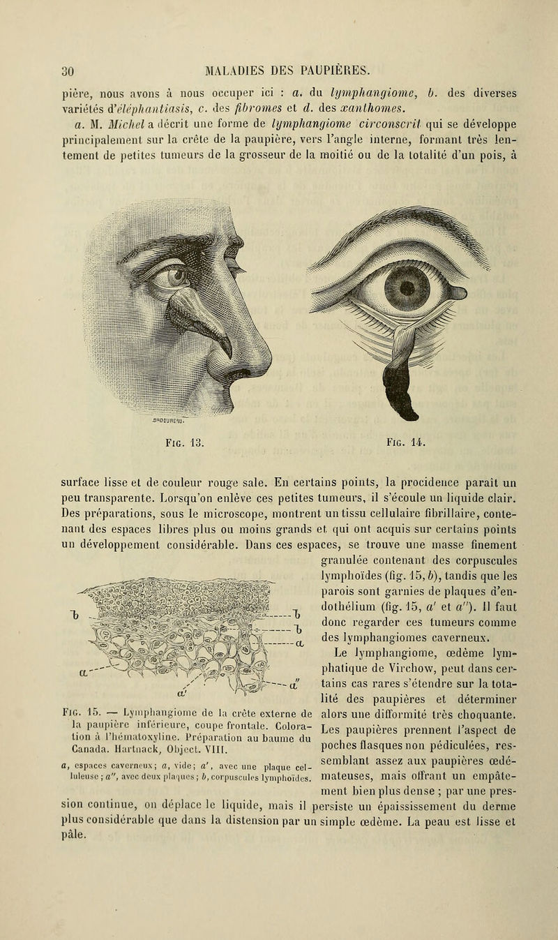 pière, nous avons à nous occuper ici : a. du lymphangiome, b. des diverses variétés A'élépkantiasis, c. des fibromes et d. des xanthomes. a. M. Michel a décrit une forme de lymphangiome circonscrit qui se développe principalement sur la crête de la paupière, vers l'angle interne, formant très len- tement de petites tumeurs de la grosseur de la moitié ou de la totalité d'un pois, à Fig. 13. Fig. 14. surface lisse et de couleur rouge sale. En certains points, la procidence paraît un peu transparente. Lorsqu'on enlève ces petites tumeurs, il s'écoule un liquide clair. Des préparations, sous le microscope, montrent un tissu cellulaire fibrillaire, conte- nant des espaces libres plus ou moins grands et. qui ont acquis sur certains points un développement considérable. Dans ces espaces, se trouve une masse finement granulée contenant des corpuscules lymphoïdes (fig. 15, b), tandis que les parois sont garnies de plaques d'en- dothélium (fig. 15, a' et a). 11 faut donc regarder ces tumeurs comme des lymphangiomes caverneux. Le lymphangiome, œdème lym- phatique de Virchow, peut dans cer- tains cas rares s'étendre sur la tota- lité des paupières et déterminer Fig. 15. — Lymphangiome de la crête externe de alors une difformité très choquante, la paupière inférieure coupe frontale. Colora- Les paupières prennent l'aspect de lion a I lieinaloxylinc. Préparation au baume du in -j- i- Canada. Hartnack, Objcct. VIII. Pochcs flasques non pediculees, res- a, espaces caverneux; a, vide; a', avec une plaque cel- Semblant aSSeZ aux paupières ffidé- luleuse ; a, avec deux plaques ; b, corpuscules lymphoïdes. mateuses, mais offrant un empâte- ment bien plus dense ; par une pres- sion continue, on déplace le liquide, mais il persiste un épaississement du derme plus considérable que dans la distension par un simple œdème. La peau est lisse et pâle.
