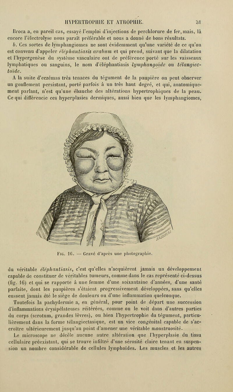 Rroca a, eu pareil cas, essayé l'emploi d'injections de perchlorure de fer, mais, là encore l'électrolyse nous paraît préférable et nous a donné de bons résultats. b. Ces sortes de lymphangiomes ne sont évidemment qu'une variété de ce qu'on est convenu d'appeler éléphantiasis arabum et qui prend, suivant que la dilatation et l'hypergenèse du système vasculaire ont de préférence porté sur les vaisseaux lymphatiques ou sanguins, le nom d'éléphantiasis lymphangoïdc ou télangiec- toïde. A la suite d'eczémas très tenaces du tégument de la paupière on peut observer un gonflement persistant, porté parfois à un très haut degré, et qui, anatomique- ment parlant, n'est qu'une ébauche des altérations hypertrophiques de la peau. Ce qui différencie ces hyperplasies dermiques, aussi bien que les lymphangiomes, FiG. 16. — Gravé d'après une photographie. du véritable éléphantiasis, c'est qu'elles n'acquièrent jamais un développement capable de constituer de véritables tumeurs, comme dans le cas représenté ci-dessus (fig. 16) et qui se rapporte à une femme d'une soixantaine d'années, d'une santé parfaite, dont les paupières s'étaient progressivement développées, sans qu'elles eussent jamais été le siège de douleurs ou d'une inflammation quelconque. Toutefois la pachydermie a, en général, pour point de départ une succession d'inflammations érysipélaleuses réitérées, comme on le voit dans d'autres parties du corps (scrotum, grandes lèvres), ou bien l'hypertrophie du tégument, particu- lièrement dans la forme télangiectasique, est un vice congénital capable de s'ac- croître ultérieurement jusqu'au point d'amener une véritable monstruosité. Le microscope ne décèle aucune autre altération que l'hyperplasie du tissu cellulaire préexistant, qui se trouve infiltré d'une sérosité claire tenant en suspen- sion un nombre considérable de cellules lymphoïdes. Les muscles et les autres