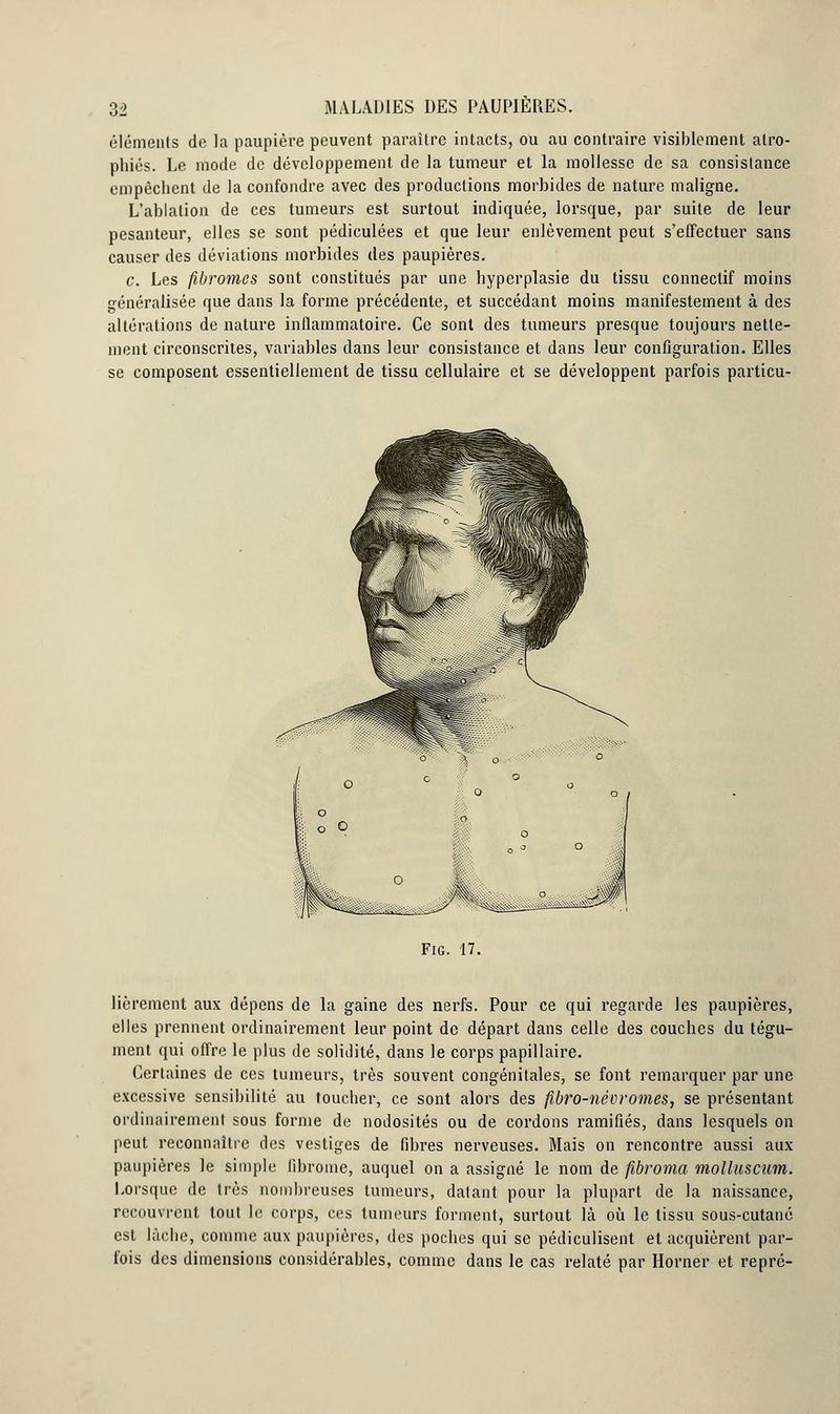 éléments de la paupière peuvent paraître intacts, ou au contraire visiblement atro- phiés. Le mode de développement de la tumeur et la mollesse de sa consistance empêchent de la confondre avec des productions morbides de nature maligne. L'ablation de ces tumeurs est surtout indiquée, lorsque, par suite de leur pesanteur, elles se sont pédiculées et que leur enlèvement peut s'effectuer sans causer des déviations morbides des paupières. c. Les fibromes sont constitués par une hyperplasie du tissu connectif moins généralisée que dans la forme précédente, et succédant moins manifestement à des altérations de nature inflammatoire. Ce sont des tumeurs presque toujours nette- ment circonscrites, variables dans leur consistance et dans leur configuration. Elles se composent essentiellement de tissu cellulaire et se développent parfois particu- Fig. 17. lièrement aux dépens de la gaine des nerfs. Pour ce qui regarde les paupières, elles prennent ordinairement leur point de départ dans celle des couches du tégu- ment qui offre le plus de solidité, dans le corps papillaire. Certaines de ces tumeurs, très souvent congénitales, se font remarquer par une excessive sensibilité au toucher, ce sont alors des fibro-névrornes, se présentant ordinairement sous forme de nodosités ou de cordons ramifiés, dans lesquels on peut reconnaître des vestiges de fibres nerveuses. Mais on rencontre aussi aux paupières le simple fibrome, auquel on a assigné le nom de fibroma molluscum. Lorsque de très nombreuses tumeurs, datant pour la plupart de la naissance, recouvrent tout le corps, ces tumeurs forment, surtout là où le tissu sous-cutané est lâche, comme aux paupières, des poches qui se pédiculisent et acquièrent par- fois des dimensions considérables, comme dans le cas relaté par Horner et repré-