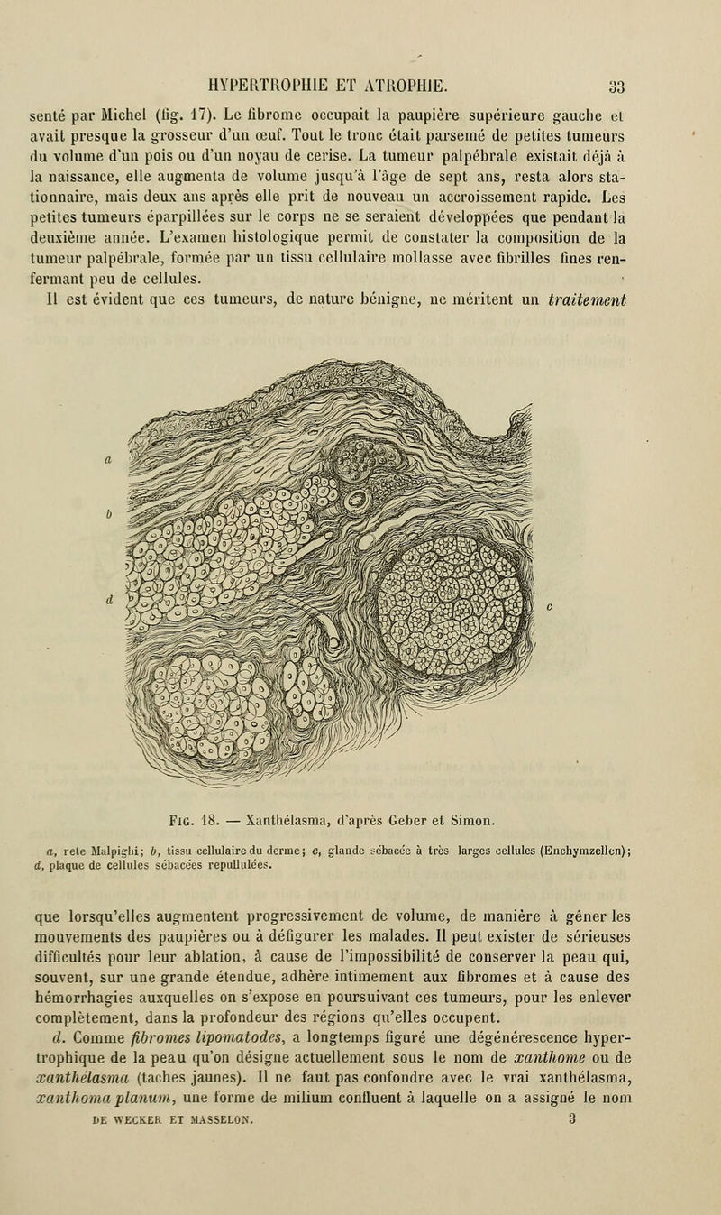 sente par Michel (lig. 17). Le fibrome occupait la paupière supérieure gauche et avait presque la grosseur d'un œuf. Tout le tronc était parsemé de petites tumeurs du volume d'un pois ou d'un noyau de cerise. La tumeur palpébrale existait déjà à la naissance, elle augmenta de volume jusqu'à l'âge de sept ans, resta alors sta- tionnaire, mais deux ans après elle prit de nouveau un accroissement rapide. Les petites tumeurs éparpillées sur le corps ne se seraient développées que pendant la deuxième année. L'examen hislologique permit de constater la composition de la tumeur palpébrale, formée par un tissu cellulaire mollasse avec fibrilles fines ren- fermant peu de cellules. 11 est évident que ces tumeurs, de nature bénigne, ne méritent un traitement d y Fig. 18. — Xanthélasma, d'après Geber et Simon. a, rete Malpig-lii; b, tissu cellulaire du derme; c, glande sébacée à très larges cellules (Enchyrazellen) ; d, plaque de cellules sébacées repullulées. que lorsqu'elles augmentent progressivement de volume, de manière à gêner les mouvements des paupières ou à défigurer les malades. Il peut exister de sérieuses difficultés pour leur ablation, à cause de l'impossibilité de conserver la peau qui, souvent, sur une grande étendue, adhère intimement aux fibromes et à cause des hémorrhagies auxquelles on s'expose en poursuivant ces tumeurs, pour les enlever complètement, dans la profondeur des régions qu'elles occupent. d. Comme fibromes lipomatodes, a longtemps figuré une dégénérescence hyper- trophique de la peau qu'on désigne actuellement sous le nom de xanthome ou de xanthélasma (taches jaunes). Jl ne faut pas confondre avec le vrai xanthélasma, xanthomaplanum, une forme de milium confluent à laquelle on a assigné le nom DE WECK.ER ET 11ASSELON. 3