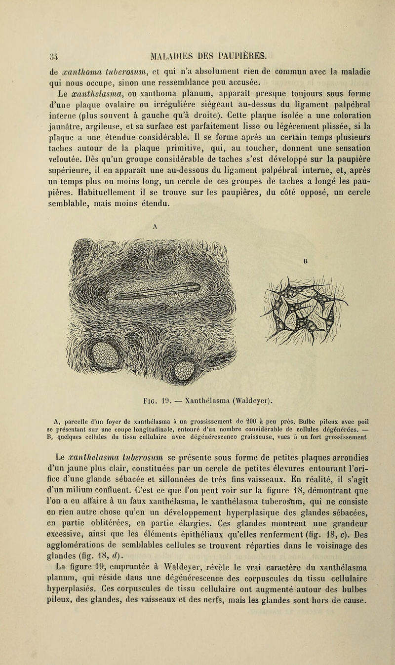 de xanthoma tuUcrosum, et qui n'a absolument rien de commun avec la maladie qui nous occupe, sinon une ressemblance peu accusée. Le xanthelasina, ou xanthoma planum, apparaît presque toujours sous forme d'une plaque ovalaire ou irrégulière siégeant au-dessus du ligament palpébral interne (plus souvent à gauche qu'à droite). Celte plaque isolée a une coloration jaunâtre, argileuse, et sa surface est parfaitement lisse ou légèrement plissée, si la plaque a une étendue considérable. Il se forme après un certain temps plusieurs taches autour de la plaque primitive, qui, au toucher, donnent une sensation veloutée. Dès qu'un groupe considérable de taches s'est développé sur la paupière supérieure, il en apparaît une au-dessous du ligament palpébral interne, et, après un temps plus ou moins long, un cercle de ces groupes de taches a longé les pau- pières. Habituellement il se trouve sur les paupières, du côté opposé, un cercle semblable, mais moins étendu. Fig. 19. — Xanthélasma (Waldeyer). A, parcelle d'un foyer de xanthélasma à un grossissement de 200 à peu près. Bulbe pileux avec poil se présentant sur une coupe longitudinale, entouré d'un nombre considérable de cellules dégénérées. — B, quelques cellules du tissu cellulaire avec dégénérescence graisseuse, vues à un fort grossissement Le xanthélasma tuberosum se présente sous forme de petites plaques arrondies d'un jaune plus clair, constituées par un cercle de petites élevures entourant l'ori- fice d'une glande sébacée et sillonnées de très fins vaisseaux. En réalité, il s'agit d'un milium confluent. C'est ce que l'on peut voir sur la figure 18, démontrant que l'on a eu affaire à un faux xanihélasma, le xanthélasma tuberostim, qui ne consiste en rien autre chose qu'en un développement hyperplasique des glandes sébacées, en partie oblitérées, en partie élargies. Ces glandes montrent une grandeur excessive, ainsi que les éléments épithéliaux qu'elles renferment (fig. 18, c). Des agglomérations de semblables cellules se trouvent réparties dans le voisinage des glandes (fig. 18, cl). La figure 19, empruntée à Waldeyer, révèle le vrai caractère du xanthélasma planum, qui réside dans une dégénérescence des corpuscules du tissu cellulaire hyperplasiés. Ces corpuscules de tissu cellulaire ont augmenté autour des bulbes pileux, des glandes, des vaisseaux et des nerfs, mais les glandes sont hors de cause.