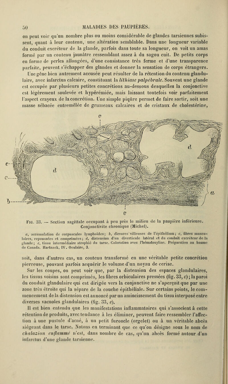 on peut voir qu'un nombre plus ou moins considérable de glandes tarsiennes subis- sent, quant à leur contenu, une altération semblable. Dans une longueur variable du conduit excréteur de la glande, parfois dans toute sa longueur, on voit un amas formé par un contenu jaunâtre ressemblant assez à du sagou cuit. De petits corps en forme de perles allongées, d'une consistance très ferme et d'une transparence parfaite, peuvent s'échapper des glandes et donner la sensation de corps étrangers. Une gêne bien autrement accusée peut résulter de la rétention du contenu glandu- laire, avec infarctus calcaire, constituant la lithiase palpébrale. Souvent une glande est occupée par plusieurs petites concrétions au-dessous desquelles la conjonctive est légèrement soulevée et hypérémiée, mais laissant toutefois voir parfaitement l'aspect crayeux de la concrétion. Une simple piqûre permet de faire sortir, soit une masse sébacée entremêlée de grumeaux calcaires et de cristaux de cholestérine, Fig. 33. — Section sagittale occupant à peu près le milieu de la paupière inférieure. Conjonctivite chronique (Michel). a, accumulation do corpuscules lymphoïdes; b, dlevurcs'villeuses de l'épithclium ; c, fibres muscu- laires, repoussées et comprimées ; d, distension d'un divcrticule latéral et du conduit excréteur de la glande; e, tissu intermédiaire atrophié du tarse. Coloration avec l'hématoxyline. Préparation au baume de Canada. Hartnack, IV. Oculaire, 3. soit, dans d'autres cas, un contenu transformé en une véritable petite concrétion pierreuse, pouvant parfois acquérir le volume d'un noyau de cerise. Sur les coupes, on peut voir que, par la distension des espaces glandulaires, les tissus voisins sont comprimés, les fibres orbieulaires pressées (fig. 33, c) ; la paroi du conduit glandulaire qui est dirigée vers la conjonctive ne s'aperçoit que par une zone très étroite qui la sépare de la couche épithéliale. Sur certains points, le com- mencement de la distension est annoncé par un amincissement du tissu interposé entre diverses vacuoles glandulaires (fig. 33, e). Il est bien entendu que les manifestations inflammatoires qui s'associent à cette rétention de produits, avec tendance à les éliminer, peuvent faire ressembler l'affec- tion à une pustule d'acné, à un petit furoncle (orgelet) ou à un véritable abcès siégeant dans le tarse. Notons en terminant que ce qu'on désigne sous le nom de chalazion enflammé n'est, dans nombre de cas, qu'un abcès formé autour d'un infarctus d'une glande tarsienne.