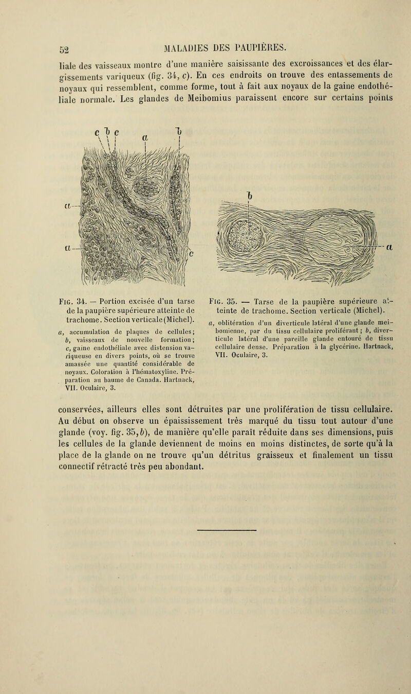 liale des vaisseaux montre d'une manière saisissante des excroissances et des élar- gissements variqueux (fig. 34, c). En ces endroits on trouve des entassements de noyaux qui ressemblent, comme forme, tout à fait aux noyaux de la gaine endothé- liale normale. Les glandes de Meibomius paraissent encore sur certains points et— ï Fig. 34. — Portion excisée d'un tarse de la paupière supérieure atteinte de trachome. Section verticale (Michel). a, accumulation de plaques de cellules; b, vaisseaux de nouvelle formation ; c, gaine endothéliale avec distension va- riqueuse en divers points, où se trouve amassée une quantité considérable de noyaux. Coloration à l'hématoxyline. Pré- paration au baume de Canada. Hartnack, VII. Oculaire, 3. Fig. 35. — Tarse de la paupière supérieure at- teinte de trachome. Section verticale (Michel). a, oblitération d'un diverticule latéral d'une glande mei- bomienne, par du tissu cellulaire proliférant; b, diver- ticule latéral d'une pareille glande entouré de tissu cellulaire dense. Préparation à la glycérine. Hartnack, VII. Oculaire, 3. conservées, ailleurs elles sont détruites par une prolifération de tissu cellulaire. Au début on observe un épaississement très marqué du tissu tout autour d'une glande (voy. fig. 35,&), de manière qu'elle paraît réduite dans ses dimensions, puis les cellules de la glande deviennent de moins en moins distinctes, de sorte qu'à la place de la glande on ne trouve qu'un détritus graisseux et finalement un tissu connectif rétracté très peu abondant.