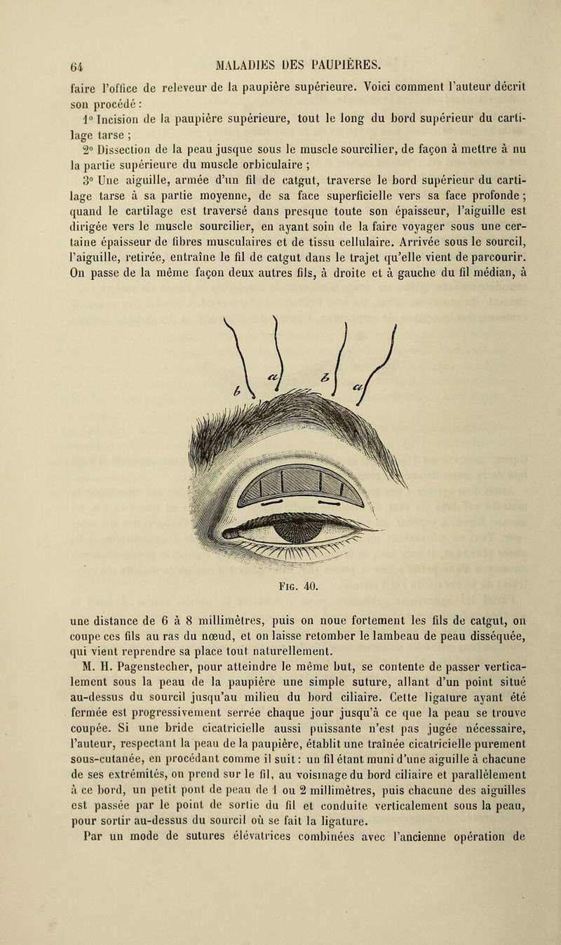 faire l'ofiice de releveur de la paupière supérieure. Voici comment l'auteur décrit son procédé : i° Incision de la paupière supérieure, tout le long du bord supérieur du carti- lage tarse ; 2° Dissection de la peau jusque sous le muscle sourcilier, de façon à mettre à nu la partie supérieure du muscle orbiculaire ; 3° Une aiguille, année d'un fil de catgut, traverse le bord supérieur du carti- lage tarse à sa partie moyenne, de sa face superficielle vers sa face profonde ; quand le cartilage est traversé dans presque toute son épaisseur, l'aiguille est dirigée vers le muscle sourcilier, en ayant soin de la faire voyager sous une cer- taine épaisseur de fibres musculaires et de tissu cellulaire. Arrivée sous le sourcil, l'aiguille, retirée, entraîne le fil de catgut dans le trajet qu'elle vient de parcourir. On passe de la même façon deux autres fils, à droite et à gauche du fil médian, à une distance de 6 à 8 millimètres, puis on noue fortement les fils de catgut, on coupe ces fils au ras du nœud, et on laisse retomber le lambeau de peau disséquée, qui vient reprendre sa place tout naturellement. M. H. Pagenstecher, pour atteindre le même but, se contente de passer vertica- lement sous la peau de la paupière une simple suture, allant d'un point situé au-dessus du sourcil jusqu'au milieu du bord ciliaire. Celte ligature ayant été fermée est progressivement serrée chaque jour jusqu'à ce que la peau se trouve coupée. Si une bride cicatricielle aussi puissante n'est pas jugée nécessaire, l'auteur, respectant la peau de la paupière, établit une traînée cicatricielle purement sous-cutanée, en procédant comme il suit : un fil étant muni d'une aiguille à chacune de ses extrémités, on prend sur le fil, au voisinage du bord ciliaire et parallèlement à ce bord, un petit pont de peau de 1 ou 2 millimètres, puis chacune des aiguilles est passée par le point de sortie du fil et conduite verticalement sous la peau, pour sortir au-dessus du sourcil où se fait la ligature. Par un mode de sutures élévatrices combinées avec l'ancienne opération de