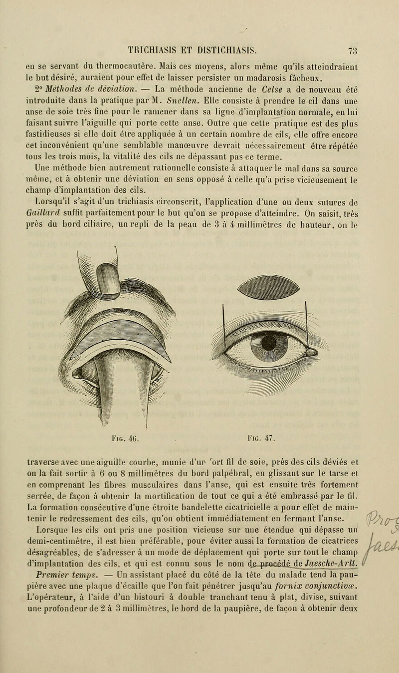 TRICHIAS1S ET DIST1CH1ASIS. 7:i en se servant du thermocautère. Mais ces moyens, alors même qu'ils atteindraient le but désiré, auraient pour effet de laisser persister un madarosis fâcheux. 2° Méthodes de déviation. — La méthode ancienne de Celse a de nouveau été introduite dans la pratique par M. Snellen. Elle consiste à prendre le cil dans une anse de soie très fine pour le ramener dans sa ligne d'implantation normale, en lui faisant suivre l'aiguille qui porte cette anse. Outre que cette pratique est des plus fastidieuses si elle doit être appliquée à un certain nombre de cils, elle offre encore cet inconvénient qu'une semblable manœuvre devrait nécessairement être répétée tous les trois mois, la vitalité des cils ne dépassant pas ce terme. Une méthode bien autrement rationnelle consiste à attaquer le mal dans sa source même, et à obtenir une déviation en sens opposé à celle qu'a prise vicieusement le champ d'implantation des cils. Lorsqu'il s'agit d'un trichiasis circonscrit, l'application d'une ou deux sutures de Gaillard suffit parfaitement pour le but qu'on se propose d'atteindre. On saisit, très près du bord ciliaire, un repli de la peau de 3 à 4 millimètres de hauteur, on le Fig. 46. Fie. 47. traverse avec une aiguille courbe, munie d'un port fil de soie, près des cils déviés et on la fait sortir à 6 ou 8 millimètres du bord palpébral, en glissant sur le tarse et en comprenant les fibres musculaires dans l'anse, qui est ensuite très fortement serrée, de façon à obtenir la mortification de tout ce qui a été embrassé par le fil. La formation consécutive d'une étroite bandelette cicatricielle a pour effet de main- tenir le redressement des cils, qu'on obtient immédiatement en fermant l'anse. Lorsque les cils ont pris une position vicieuse sur une étendue qui dépasse un demi-centimètre, il est bien préférable, pour éviter aussi la formation de cicatrices désagréables, de s'adresser à un mode de déplacement qui porte sur tout le champ d'implantation des cils, et qui est connu sous le nom d^jpmaàdêde Jaesche-Arlt. Premier temps. — Un assistant placé du côté de la tête du malade tend la pau- pière avec une plaque d'écaillé que l'on fait pénétrer jusqu'au fornix conjunctivœ. L'opérateur, à l'aide d'un bistouri à double tranchant tenu à plat, divise, suivant