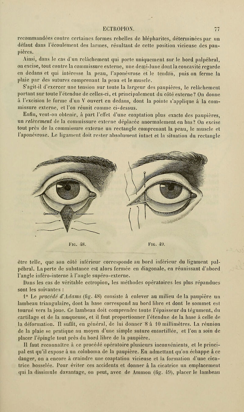 recommandées contre certaines formes rebelles de blépharites, déterminées par un défaut dans l'écoulement des larmes, résultant de cette position vicieuse des pau- pières. Ainsi, dans le cas d'un relâchement qui porte uniquement sur le bord palpébral, on excise, tout contre la commissure externe, une demi-lune dont la concavité regarde en dedans et qui intéresse la peau, l'aponévrose et le tendon, puis on ferme la plaie par des sutures comprenant la peau et le muscle. S'agit-il d'exercer une tension sur toute la largeur des paupières, le relâchement portant sur toute l'étendue de celles-ci, et principalement du côté externe? On donne à l'excision le forme d'un V ouvert en dedans, dont la pointe s'applique à la com- missure externe, et l'on réunit comme ci-dessus. Enfin, veut-on obtenir, à part l'effet d'une coaptation plus exacte des paupières, un relèvement de la commissure externe déplacée anormalement en bas? On excise tout près de la commissure externe un rectangle comprenant la peau, le muscle et l'aponévrose. Le ligament doit rester absolument, intact et la situation du rectangle Fie. Fig. 49. être telle, que son côté inférieur corresponde au bord inférieur du ligament pal- pébral. La perte de substance est alors fermée en diagonale, en réunissant d'abord l'angle inféro-interne à l'angle supéro-externe. Dans les cas de véritable ectropion, les méthodes opératoires les plus répandues sont les suivantes : 1° Le procédé d'Adams (fig. 48) consiste à enlever au milieu de la paupière un lambeau triangulaire, dont la base correspond au bord libre et dont le sommet est tourné vers la joue. Ce lambeau doit comprendre toute l'épaisseur du tégument, du cartilage et de la muqueuse, et il faut proportionner l'étendue de la base à celle de la déformation. Il suffit, en général, de lui donner 8 à 10 millimètres. La réunion de la plaie se pratique au moyen d'une simple suture entortillée, et l'on a soin de placer l'épingle tout près du bord libre de la paupière. Il faut reconnaître à ce procédé opératoire plusieurs inconvénients, et le princi- pal est qu'il expose à un coloboma de la paupière. En admettant qu'on échappe à ce danger, on a encore à craindre une coaptation vicieuse et la formation d'une cica- trice bosselée. Pour éviter ces accidents et donner à la cicatrice un emplacement qui la dissimule davantage, on peut, avec de Ammon (fig. 49), placer le lambeau