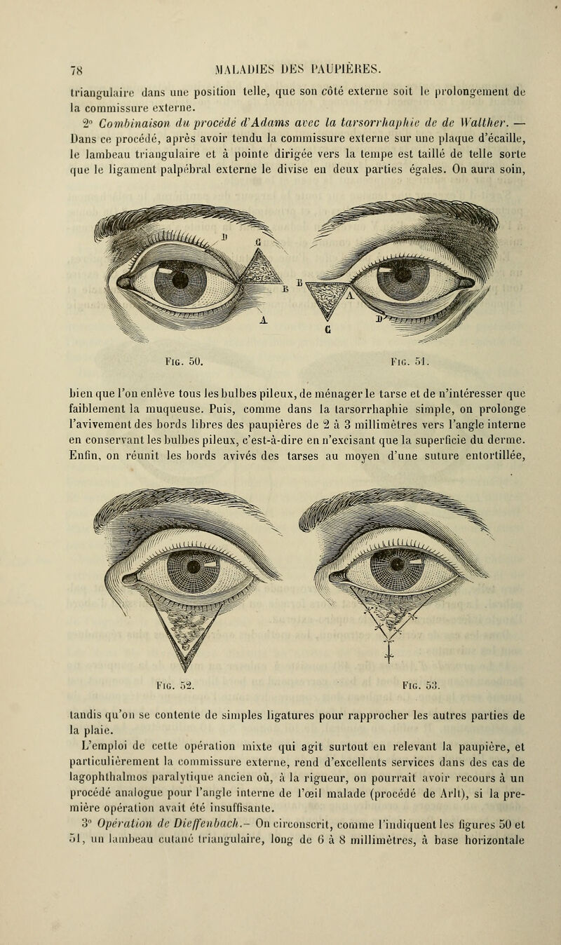 triangulaire dans une position telle, que son côté externe soit le prolongement de la commissure externe. 2° Combinaison du procédé d'Adams avec la tarsorrhaphie de de Walther. — Dans ce procédé, après avoir tendu la commissure externe sur une plaque d'écaillé, le lambeau triangulaire et à pointe dirigée vers la tempe est taillé de telle sorte que le ligament palpébral externe le divise en deux parties égales. On aura soin, Fig. 50. Fig. 51. bien que l'on enlève tous les bulbes pileux, de ménagerie tarse et de n'intéresser que faiblement la muqueuse. Puis, comme dans la tarsorrhaphie simple, on prolonge l'avivement des bords libres des paupières de 2 à 3 millimètres vers l'angle interne en conservant les bulbes pileux, c'est-à-dire en n'excisant que la superficie du derme. Enfin, on réunit les bords avivés des tarses au moyen d'une suture entortillée, Fig. 52. Fig. 53. tandis qu'on se contente de simples ligatures pour rapprocher les autres parties de la plaie. L'emploi de cette opération mixte qui agit surtout en relevant la paupière, et particulièrement la commissure externe, rend d'excellents services dans des cas de lagophthalmos paralytique ancien où, à la rigueur, on pourrait avoir recours à un procédé analogue pour l'angle interne de l'œil malade (procédé de Arlt), si la pre- mière opération avait été insuffisante. 3° Opération de Dicffenbach.- On circonscrit, comme l'indiquent les figures 50 et