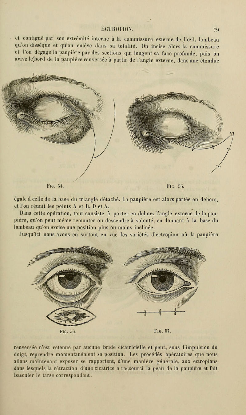 et contiguë par son extrémité interne à Ja commissure externe de JPœii, lambeau qu'on dissèque et qu'on enlève dans sa totalité. On incise alors îa commissure et l'on dégage la paupière par des sections qui longent sa face profonde, puis on avive le;bord de la paupière renversée à partir de l'angle externe, dans une étendue Fie 54. Fig. 55. égale à celle de la base du triangle détaché. La paupière est alors portée en dehors, et l'on réunit les points A et B, D et A. Dans cette opération, tout consiste à porter en dehors l'angle externe de la pau- pière, qu'on peut même remonter ou descendre à volonté, en donnant à la base du lambeau qu'on excise une position plus ou moins inclinée. Jusqu'ici nous avons eu surtout en vue les variétés d'ectropion où la paupière Fig. 56. Fig. 57. renversée n'est retenue par aucune bride cicatricielle et peut, sous l'impulsion du doigt, reprendre momentanément sa position. Les procédés opératoires que nous allons maintenant exposer se rapportent, d'une manière générale, aux ectropions dans lesquels la rétraction d'une cicatrice a raccourci la peau de la paupière et fait basculer le tarse correspondant.