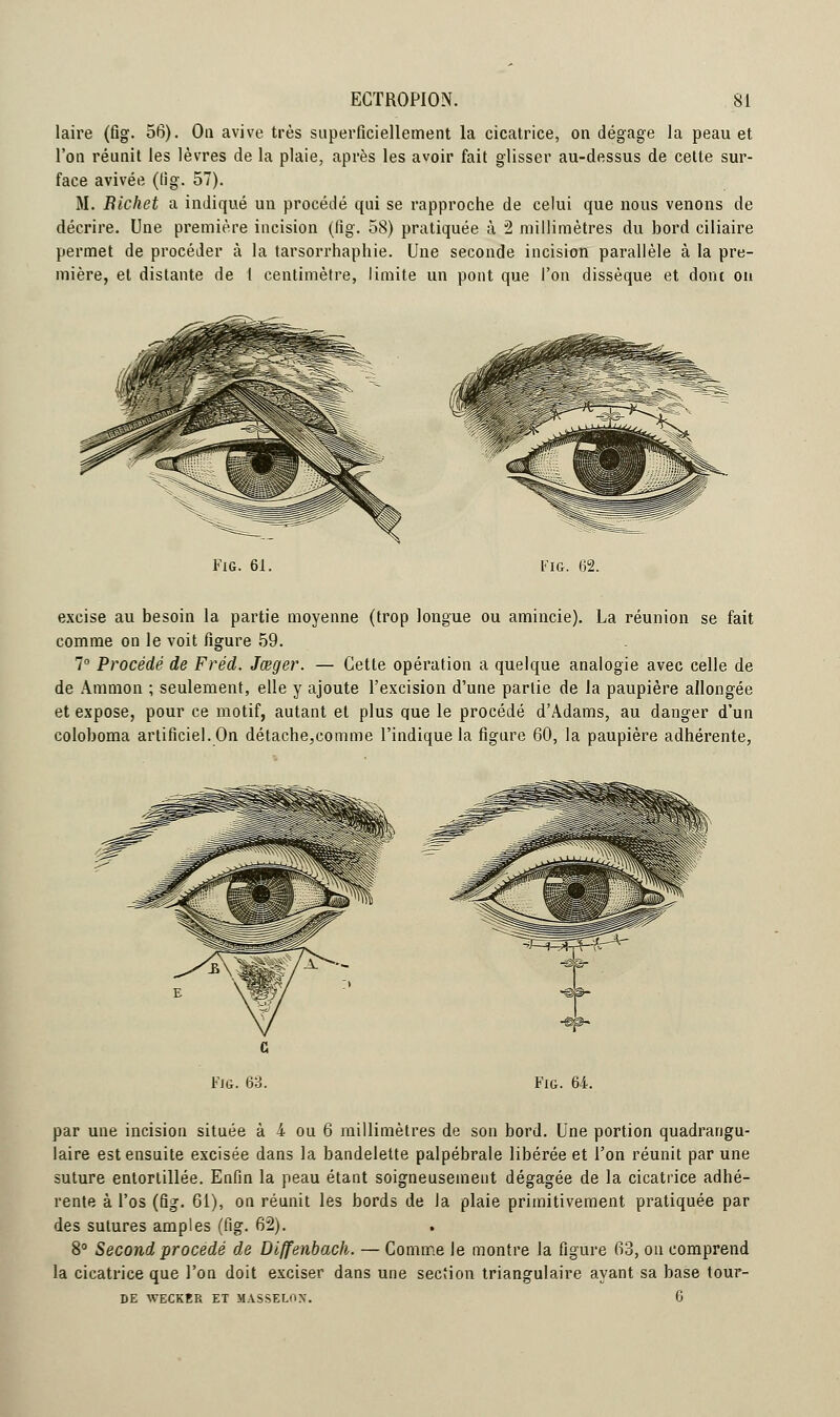 laire (fig. 56). On avive très superficiellement la cicatrice, on dégage la peau et l'on réunit les lèvres de la plaie, après les avoir fait glisser au-dessus de cette sur- face avivée (lig. 57). M. Bicket a indiqué un procédé qui se rapproche de celui que nous venons de décrire. Une première incision (lig. 58) pratiquée à 2 millimètres du bord ciliaire permet de procéder à la tarsorrhaphie. Une seconde incision parallèle à la pre- mière, et distante de 1 centimètre, limite un pont que l'on dissèque et dont on Fig. 61. Fig. 62. excise au besoin la partie moyenne (trop longue ou amincie). La réunion se fait comme on le voit figure 59. 7° Procédé de Fréd. Jœger. — Cette opération a quelque analogie avec celle de de Ammon ; seulement, elle y ajoute l'excision d'une partie de la paupière allongée et expose, pour ce motif, autant et plus que le procédé d'Àdams, au danger d'un coloboma artificiel. On détache,comme l'indique la figure 60, la paupière adhérente, Fig. 64. par une incision située à 4 ou 6 millimètres de son bord. Une portion quadrangu- laire est ensuite excisée dans la bandelette palpébrale libérée et l'on réunit par une suture entortillée. Enfin la peau étant soigneusement dégagée de la cicatrice adhé- rente à l'os (fig. 61), on réunit les bords de la plaie primitivement pratiquée par des sutures amples (fig. 62). 8° Second procédé de Diffenbach. — Comme le montre la figure 63, on comprend la cicatrice que l'on doit exciser dans une section triangulaire ayant sa base tour- DE WECKER ET MASSELOX. 6