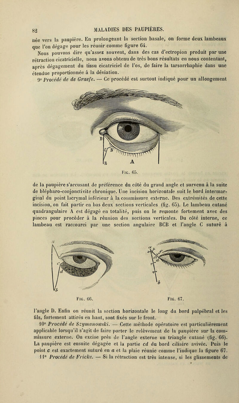 née vers la paupière. En prolongeant la section basale, on forme deux lambeaux que l'on dégage pour les réunir comme figure 64. Nous pouvons dire qu'assez souvent, dans des cas d'ectropion produit par une rétraction cicatricielle, nous avons obtenu de très bons résultats en nous contentant, après dégagement du tissu cicatriciel de l'os, de faire la larsorrhaphie dans une étendue proportionnée à la déviation. 9° Procédé de de Graefe. — Ce procédé est surtout indiqué pour un allongement de la paupière s'accusant de préférence du côté du grand angle et survenu à la suite de blépharo-conjonctivite chronique. Une incision horizontale suit le bord intermar- ginal du point lacrymal inférieur à la commissure externe. Des extrémités de cette incision, on fait partir en bas deux sections verticales (fig. 65). Le lambeau cutané quadrangulaire A est dégagé en totalité, puis on le remonte fortement avec des pinces pour procéder à la réunion des sections verticales. Du côté interne, ce lambeau est raccourci par une section angulaire BCB et l'angle C suturé à Fig. 66. Fig. 67. l'angle D. Enfin on réunit la section horizontale le long du bord palpébral et les fils, fortement attirés en haut, sont fixés sur le front. 10° Procédé de Szymanowski. — Cette méthode opératoire est particulièrement applicable lorsqu'il s'agit de faire porter le relèvement de la paupière sur la com- missure externe. On excise près de l'angle externe un triangle cutané (fig. 66). La paupière est ensuite dégagée et la partie cd du bord ciliaire avivée. Puis le point c est exactement suturé en a et la plaie réunie comme l'indique la figure 67. 11° Procédé de Friche. — Si la rétraction est très intense, si les glissements de