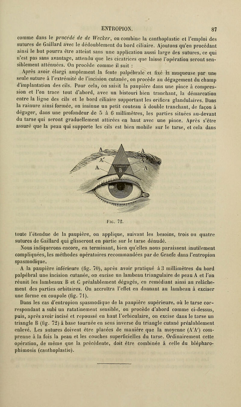 comme dans le procédé de de Wecker, on combine la canthoplastie et l'emploi des sulures de Gaillard avec le dédoublement du bord ciliaire. Ajoutons qu'en procédant ainsi le but pourra être atteint sans une application aussi large des sutures, ce qui n'est pas sans avantage, attemlu que les cicatrices que laisse l'opération seront sen- siblement atténuées. On procède comme il suit : Après avoir élargi amplement la fente palpébrale et fixé la muqueuse par une seule suture à l'extrémité de l'incision cutanée, on procède au dégagement du champ d'implantation des cils. Pour cela, on saisit la paupière dans une pince à compres- sion et l'on trace tout d'abord, avec un bistouri bien tranchant, la démarcation entre la ligne des cils et le bord ciliaire supportant les orifices glandulaires. Dans la rainure ainsi formée, on insinue un petit, couteau à double tranchant, de façon à dégager, dans une profondeur de 5 à 6 millimètres, les parties situées au-devant du tarse qui seront graduellement attirées en haut avec une pince. Après s'être assuré que la peau qui supporte les cils est bien mobile sur le tarse, et cela dans Fig. 72. toute l'étendue de la paupière, on applique, suivant les besoins, trois ou quatre sutures de Gaillard qui glisseront en partie sur le tarse dénudé. Nous indiquerons encore, en terminant, bien qu'elles nous paraissent inutilement compliquées, les méthodes opératoires recommandées par de Graefe dans l'entropion spasmodique. A la paupière inférieure (fig. 70), après avoir pratiqué à 3 millimètres du bord palpébral une incision cutanée, on excise un lambeau triangulaire de peau A et l'on réunit les lambeaux B et C préalablement dégagés, en remédiant ainsi au relâche- ment des parties orbitaires. On accroîtra l'effet en donnant au lambeau à exciser une forme en coupole (fig. 71). Dans les cas d'entropion spasmodique de la paupière supérieure, où le tarse cor- respondant a subi un ratatinement sensible, on procède d'abord comme ci-dessus, puis, après avoir incisé et repoussé en haut l'orbiculaire, on excise dans le tarse un triangle B (fig. 72) à base tournée en sens inverse du triangle cutané préalablement enlevé. Les sutures doivent être placées de manière que la moyenne (A'A') com- prenne à la fois la peau et les couches superficielles du tarse. Ordinairement cette opération, de même que la précédente, doit être combinée à celle du blépharo- phimosis (canthoplastie).