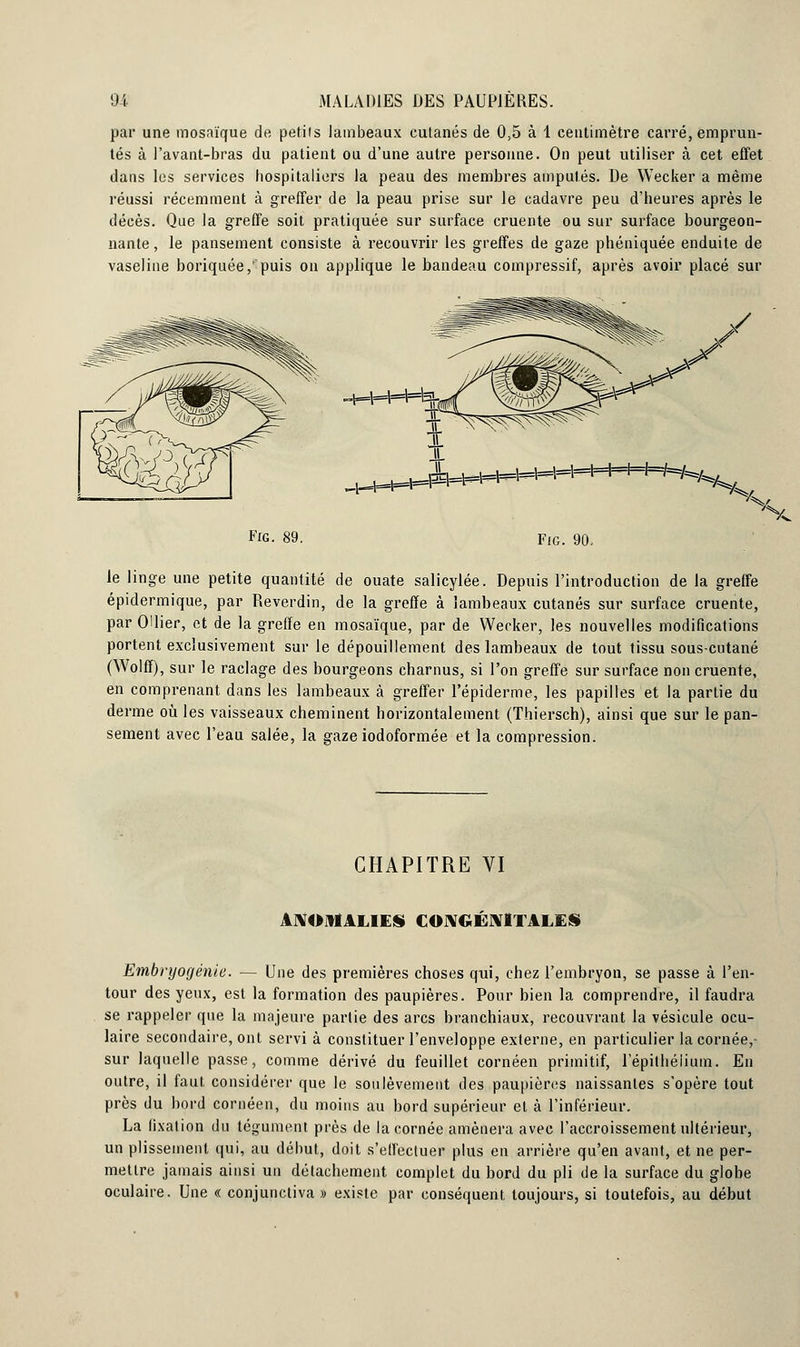 par une mosaïque de petits lambeaux cutanés de 0,5 à 1 centimètre carré, emprun- tés à l'avant-bras du patient ou d'une autre personne. On peut utiliser à cet effet dans les services hospitaliers la peau des membres amputés. De Wecker a même réussi récemment à greffer de la peau prise sur le cadavre peu d'heures après le décès. Que la greffe soit pratiquée sur surface cruente ou sur surface bourgeon- nante , le pansement consiste à recouvrir les greffes de gaze phéniquée enduite de vaseline boriquée/puis on applique le bandeau compressif, après avoir placé sur *HHrH9k ^H-M-l-P5*-** Fig. 89. Fig. 90, le linge une petite quantité de ouate salicylée. Depuis l'introduction de la greffe épidermique, par Reverdin, de la greffe à lambeaux cutanés sur surface cruente, par Ollier, et de la greffe en mosaïque, par de Wecker, les nouvelles modifications portent exclusivement sur le dépouillement des lambeaux de tout tissu sous-cutané (Wolff), sur le raclage des bourgeons charnus, si l'on greffe sur surface non cruente, en comprenant dans les lambeaux à greffer l'épiderme, les papilles et la partie du derme où les vaisseaux cheminent horizontalement (Thiersch), ainsi que sur le pan- sement avec l'eau salée, la gaze iodoformée et la compression. CHAPITRE VI ANOMALIES CONGÉNITALES Embryogénie. — Une des premières choses qui, chez l'embryon, se passe à l'en- tour des yeux, est la formation des paupières. Pour bien la comprendre, il faudra se rappeler que la majeure partie des arcs branchiaux, recouvrant la vésicule ocu- laire secondaire, ont servi à constituer l'enveloppe externe, en particulier la cornée,- sur laquelle passe, comme dérivé du feuillet cornéen primitif, lepithéiium. En outre, il faut considérer que le soulèvement des paupières naissantes s'opère tout près du bord cornéen, du moins au bord supérieur et à l'inférieur. La fixation du tégument près de la cornée amènera avec l'accroissement ultérieur, un plissement qui, au début, doit s'effectuer plus en arrière qu'en avant, et ne per- mettre jamais ainsi un détachement complet du bord du pli de la surface du globe oculaire. Une « conjunctiva » existe par conséquent toujours, si toutefois, au début