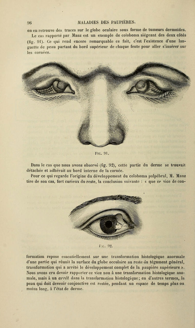 on eu retrouve des traces sur le globe oculaire sous forme de tumeurs dermoïdes. Le cas rapporté par Manz est un exemple de coloboma siégeant des deux côtés (fig. 91). Ce qui rend encore remarquable ce fait, c'est l'existence d'une lan- guette de peau partant du bord supérieur de chaque fente pour aller s'insérer sur les cornées. Fig. 91. Dans le cas que nous avons observé (fig. 92), cette partie du derme se trouvait détachée et adhérait au bord interne de la cornée. Pour ce qui regarde l'origine du développement du coloboma palpébral, M. Manz tire de son cas, fort curieux du reste, la conclusion suivante : « que ce vice de con- formation repose essentiellement sur une transformation histologique anormale d'une partie qui réunit la surface du globe occulaire au reste du tégument général, transformation qui a arrêté le développement complet de la paupière supérieure ». Nous avons cru devoir rapporter ce vice non à une transformation histologique ano- male, mais à un arrêt dans la transformation histologique; en d'autres termes, la peau qui doit devenir conjonctive est restée, pendant un espace de temps plus ou moins lonsf, à l'état de derme.