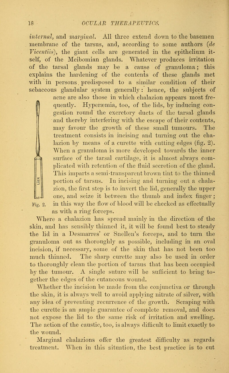 internal, and marginal. All three extend down to the basemen membrane of the tarsus, and, according to some authors (de Vicentiis), the giant cells are generated in the epithelium it- self, of the Meibomian glands. Whatever produces irritation of the tarsal glands may be a cause of granuloma; this explains the hardening of the contents of these glands met with in persons. predisposed to a similar condition of their sebaceous glandular system generally: hence, the subjects of acne are also those in which chalazion appears most fre- H quently. Hypersemia, too, of the lids, by inducing con- gestion round the excretory ducts of the tarsal glands • and thereby interfering with the escape of their contents, may favour the growth of these small tumours. The treatment consists in incising and turning out the cha- lazion hy means of a curette with cutting edges (fig. 2). When a granuloma is more developed towards the inner surface of the tarsal cartilage, it is almost alwa}rs com- plicated with retention of the fluid secretion of the gland. This imparts a semi-transparent brown tint to the thinned portion of tarsus. In incising and turning out a chala- zion, the first step is to.invert the lid, generally the upper one, and seize it between the thumb and index finger; Fig. 2. in this way the flow of blood will be checked as effectually as with a ring forceps. Where a chalazion has spread mainly in the direction of the skin, and has sensibly thinned it, it will be found best to steady the lid in a Desmarres' or Snellen's forceps, and to turn the granuloma out as thoroughly as possible, including in an oval incision, if necessary, some of the skin that has not been too much thinned. The sharp curette may also be used in order to thoroughly clean the portion of tarsus that has been occupied by the tumour. A single suture will be sufficient to bring to- gether the edges of the cutaneous wound. Whether the incision be made from the conjunctiva or through the skin, it is alwa}Ts well to avoid applying nitrate of silver, with any idea of preventing recurrence of the growth. Scraping with the curette is an ample guarantee of complete removal, and does not expose the lid to the same risk of irritation, and swelling. The action of the caustic, too, is always difficult to limit exactly to the wound. Marginal chalazions offer the greatest difficulty as regards treatment. When in this situation, the best practice is to cut