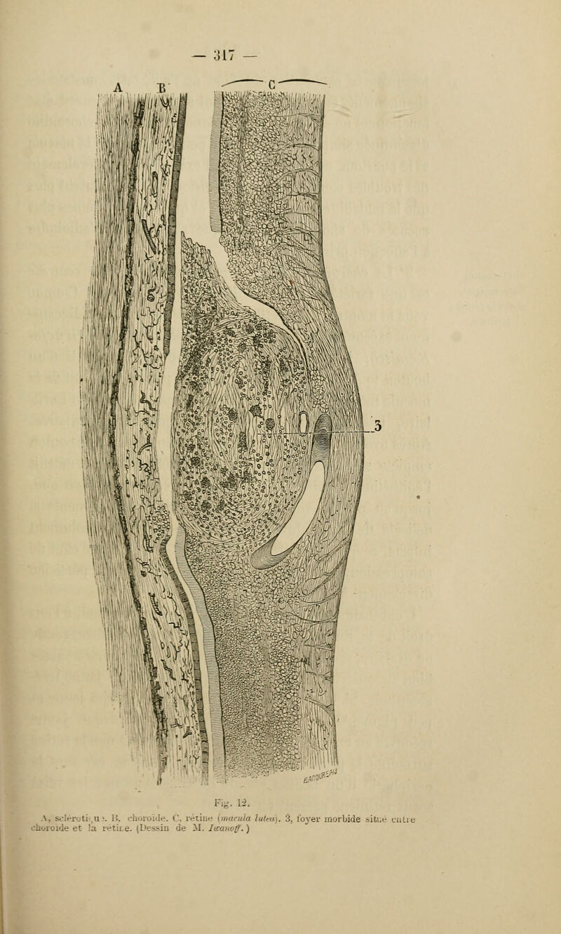 ;;r | :•;.. , ;- ',! 'ii ','-1 wË të£Ê*&$^ U*J If '^% P11P M fer ;- - R2?'J g. 13. éroti a-, i:. - rétine (macula lutea). 3, loyer morbide situé entre choroïde et !u rétine. (Dessin de M. litatioff. )