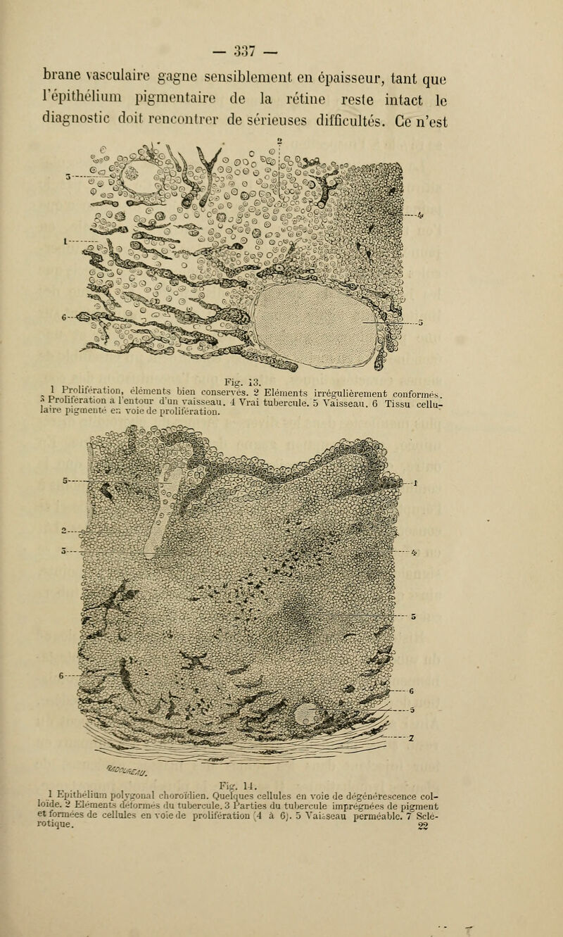 brane vasculaire gagne sensiblement en épaisseur, tant que répithélium pigmentaire de la rétine reste intact le diagnostic doit rencontrer de sérieuses difficultés. Ce n'est Fis. 13. 1 Prolifération, éléments bien conserves. 2 Eléments irrégulièrement conformés ••« Froliieration a 1 entour d'un vaisseau. 1 Vrai tubercule. 5 Vaisseau. 6 Tissu cellu- laire pigmenté en voie de prolifération. :- ■-■--■■y. Pig. 14. 1 Epithéliom polygonal ehoroïdien. Quelques cellules en voie de dégénérescence col- loïde. 2 Eléments détonnes du tubercule. 3 Parties du tubercule imprégnées de piement et formées de cellules en voie de prolifération 'A à Gj. 5 Vaisseau perméable, f Sclé- rotique . 22