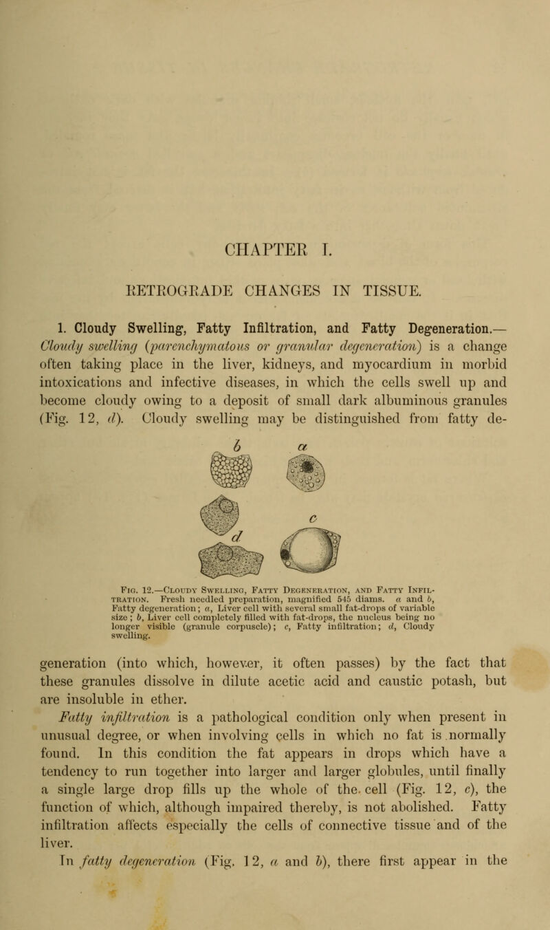 EETROGKADE CHANGES IN TISSUE. 1. Cloudy Swelling, Fatty Infiltration, and Fatty Degeneration.— Cloudy swelling (parenchymatous or granular degeneration) is a change often taking place in the liver, kidneys, and myocardium in morbid intoxications and infective diseases, in which the cells swell up and become cloudy owing to a deposit of small dark albuminous granules (Fig. 12, d). Cloudy swelling may be distinguished from fatty de- FiG. 12.—Cloudy Swelling, Fatty Degeneration, and Fatty Infil- tration. Fresh needled preparation, magnified 545 diams. a and b, Fatty degeneration; «, Liver cell with several small fat-drops of variable size; h. Liver cell completely filled with fat-drops, the nucleus being no longer visible (granule corpuscle); c, Fatty infiltration; d, Cloudy swelling. generation (into which, however, it often passes) by the fact that these granules dissolve in dilute acetic acid and caustic potash, but are insoluble in ether. Fatty infiltration is a pathological condition only when present in unusual degree, or when involving cells in which no fat is.normally found. In this condition the fat appears in drops which have a tendency to run together into larger and larger globules, until finally a single large drop fills up the whole of the. cell (Fig. 12, c), the function of which, although impaired thereby, is not abolished. Fatty infiltration affects especially the cells of connective tissue and of the liver. In fatty degeneration (Fig. 12, a and h), there first appear in the